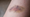 Do you let bruises heal?