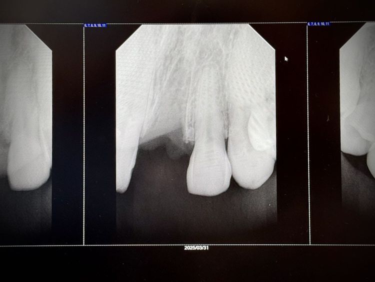 Mountain Biking Finally Cost Me a Tooth
