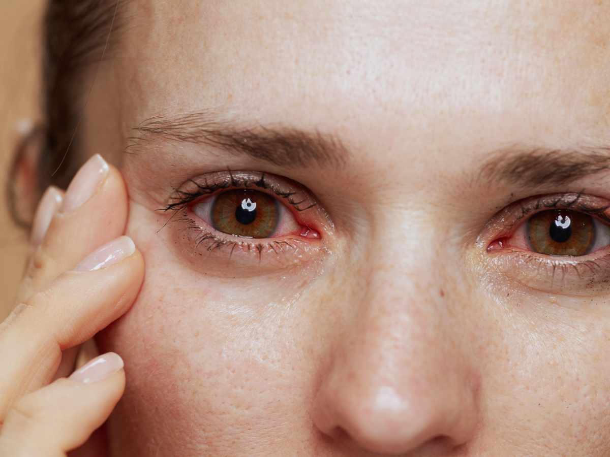 Closeup of woman starting at us with red, itchy damaged eyes.