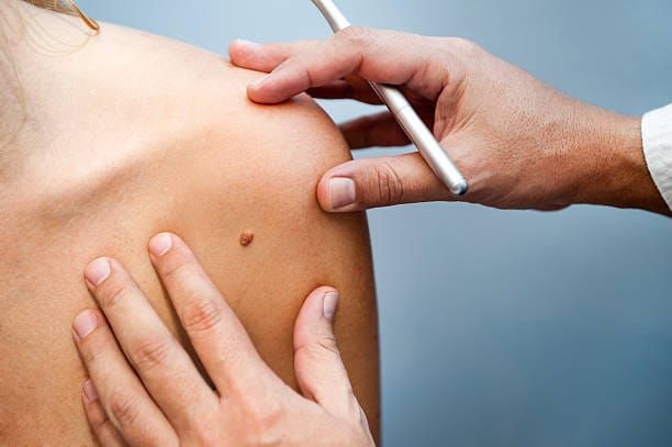 Skin cancer warning for Riverlanders post image