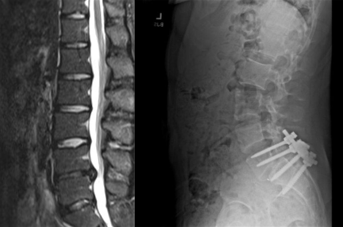 Left: MRI image of my spine from early 2020. Right: X-ray of Luigi Mangione's back.