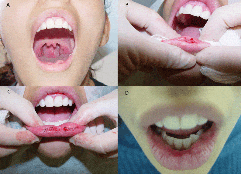 Surgical correction of the labial pits through navicular incision along the lower lip semi mucosa, followed by excision and layered closure6.