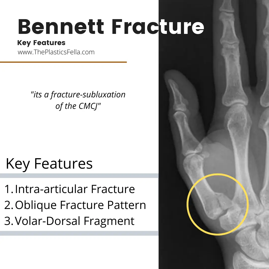 Features of a Bennett Fracture on X-Ray