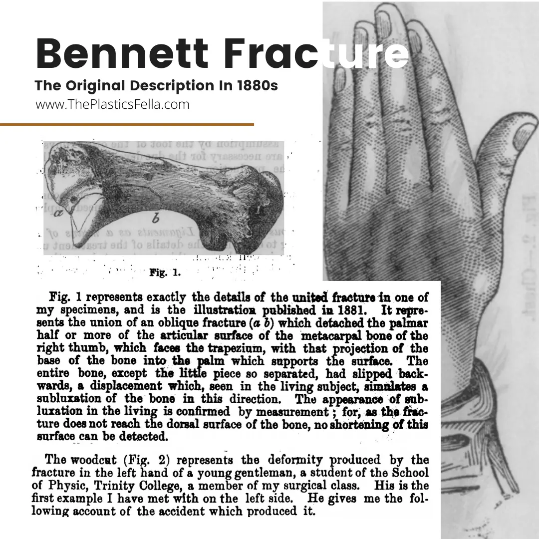 The original publication by EH Bennet in 1880s