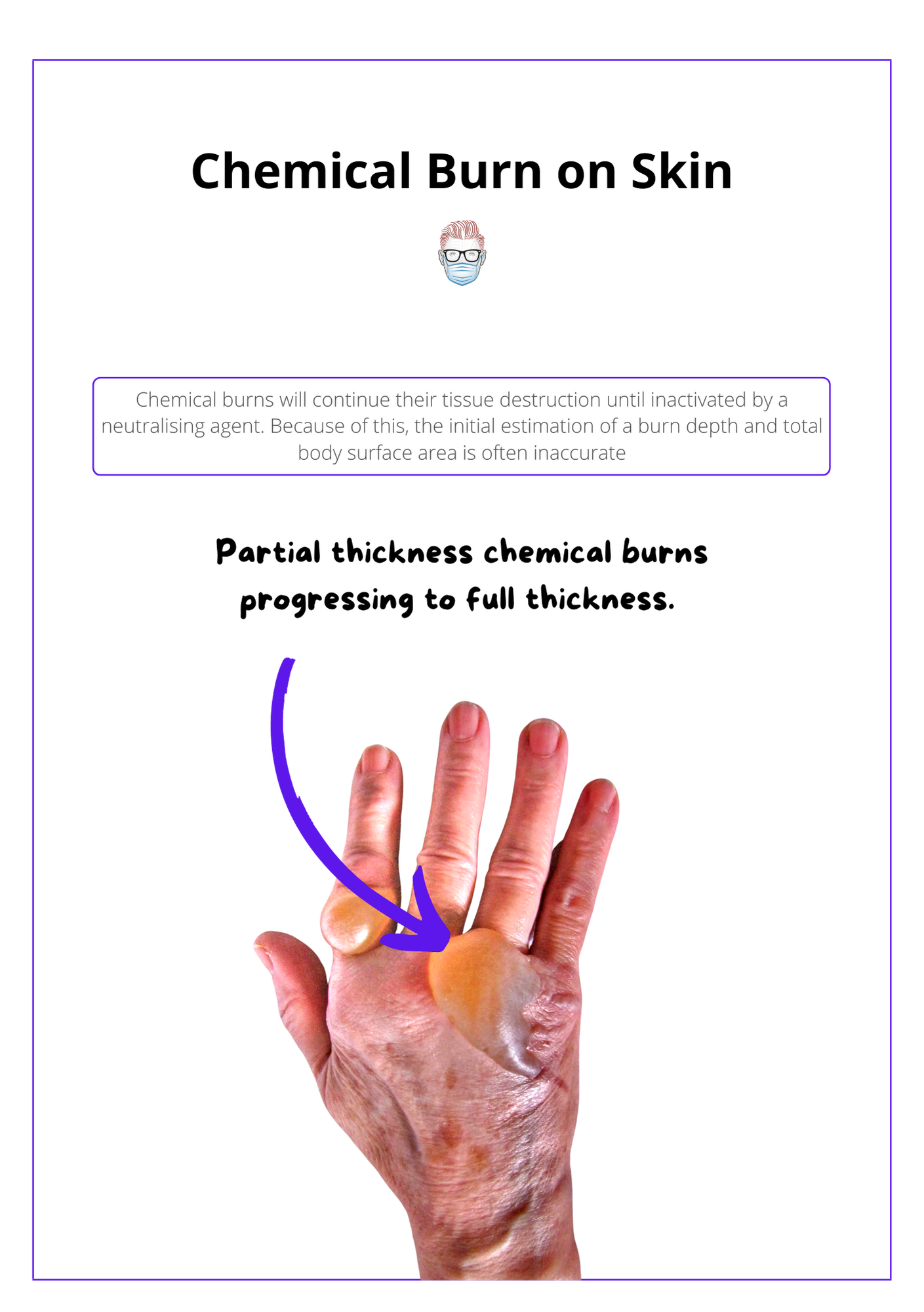 Chemical Burn on Skin