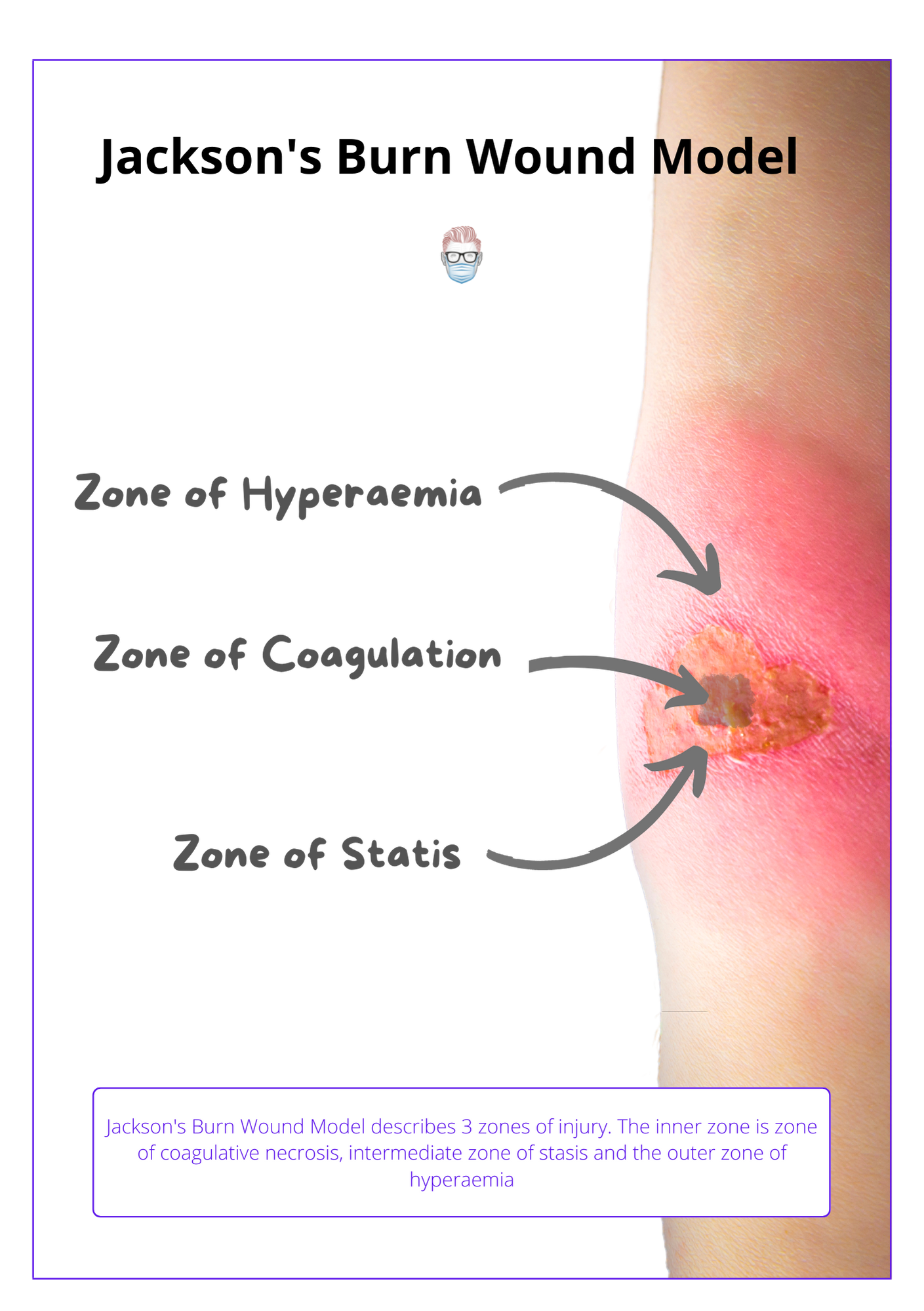Jackson's Burn Wound Model, Classification of burns, burn injuries