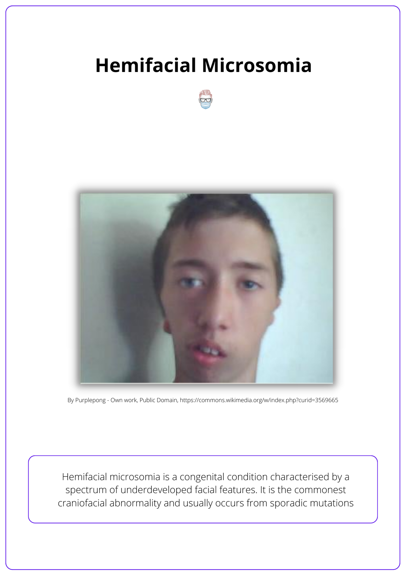 Presentation of hemifacial microsomia 