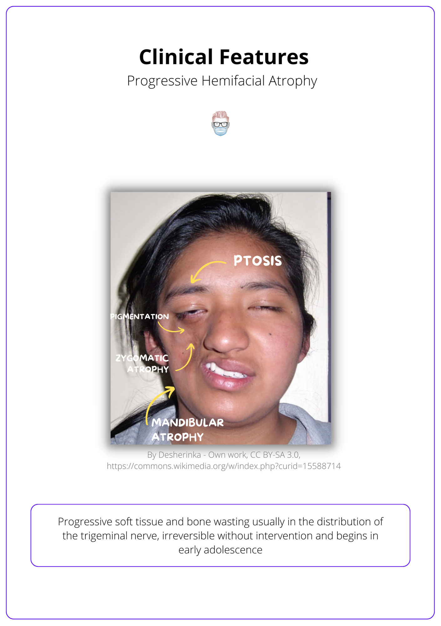 Clinical Features of Progressive Hemifacial Atrophy, Identifying Parry Romberg Disease