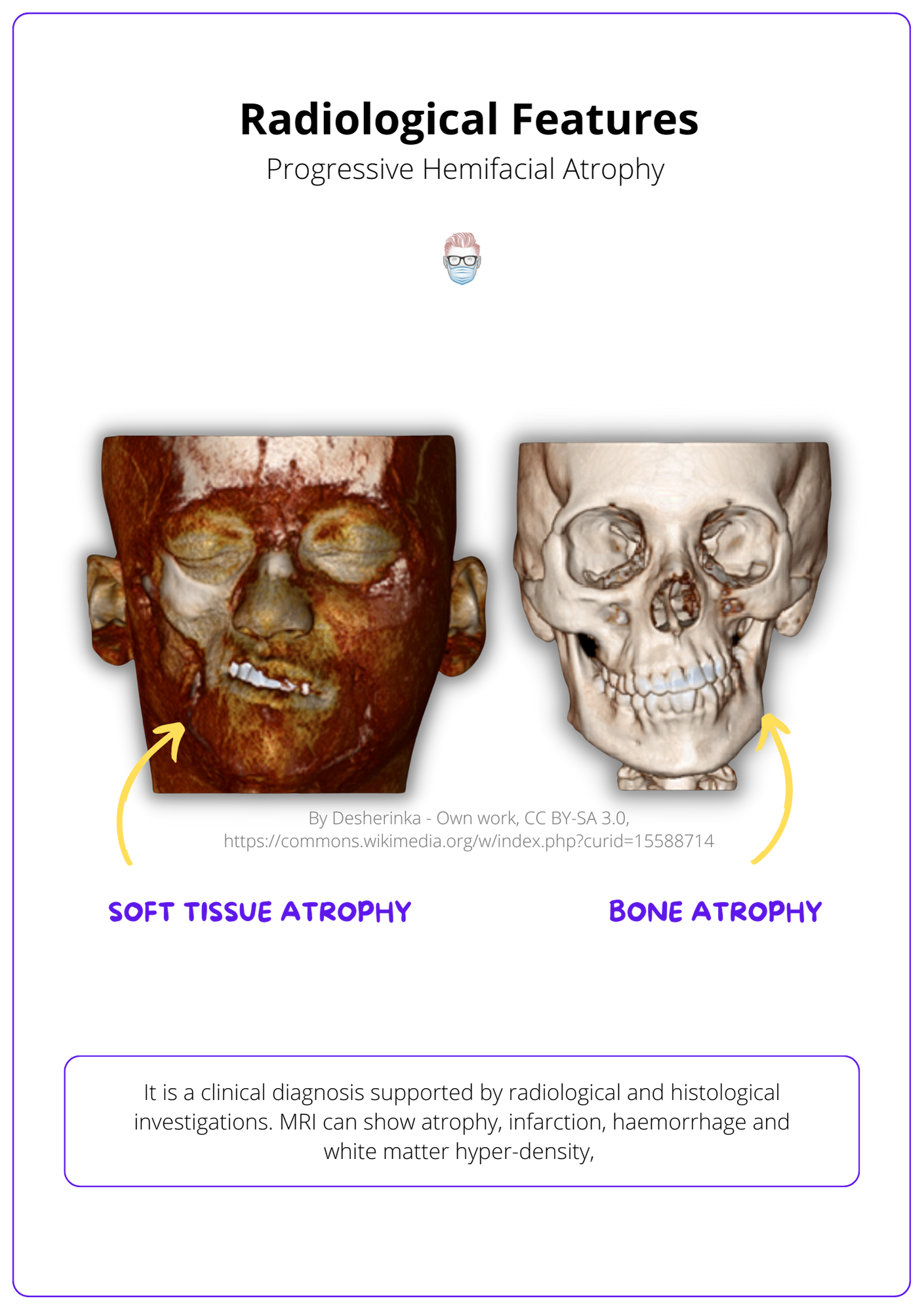 Radiological features of progressive hemifacial atrophy, Diagnosing progressive hemifacial atrophy