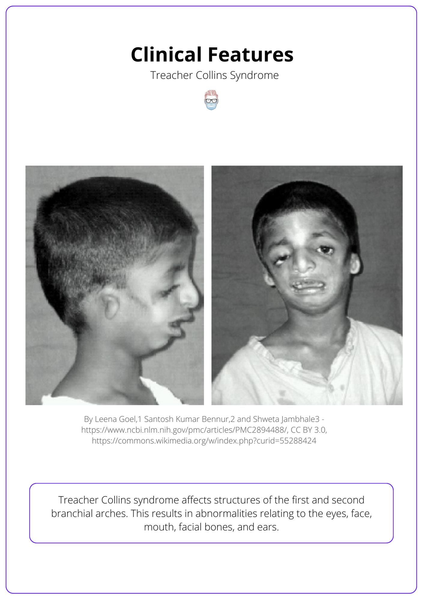 Treacher Collins syndrome example