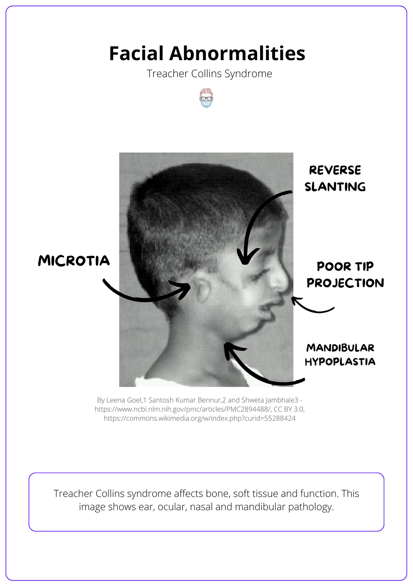 Signs of Treacher Collins syndrome