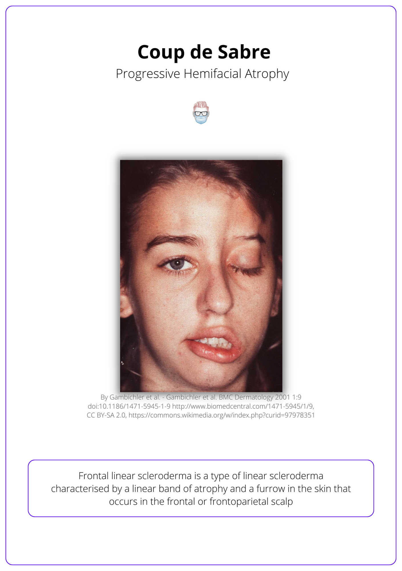 coup de sabre of progressive hemifacial atrophy, Identifying Parry Romberg Disease
