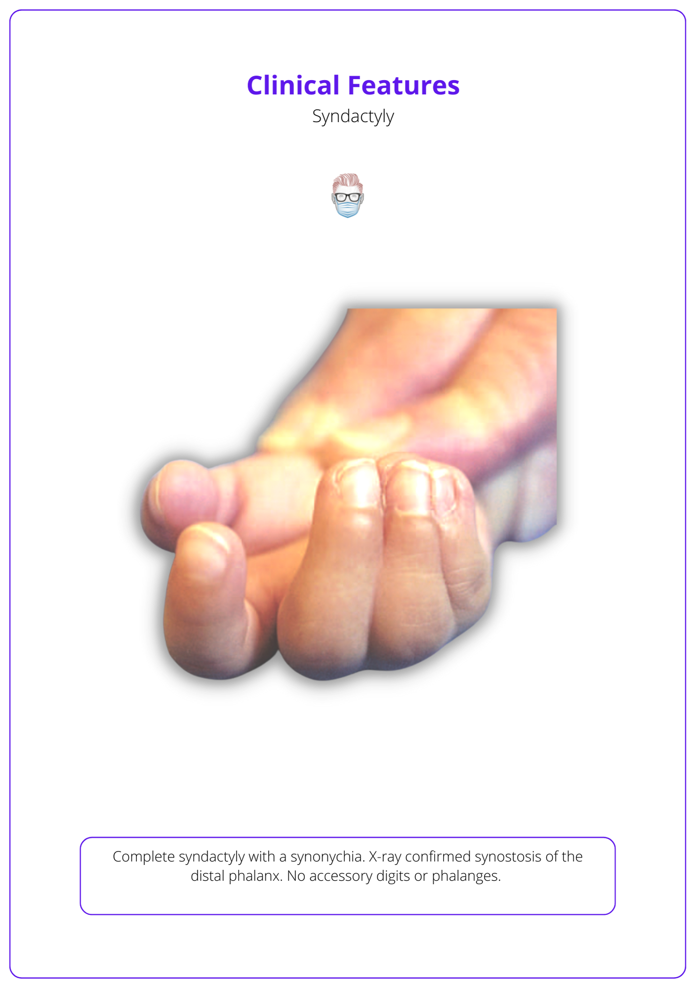 Clinical features of Syndactyly