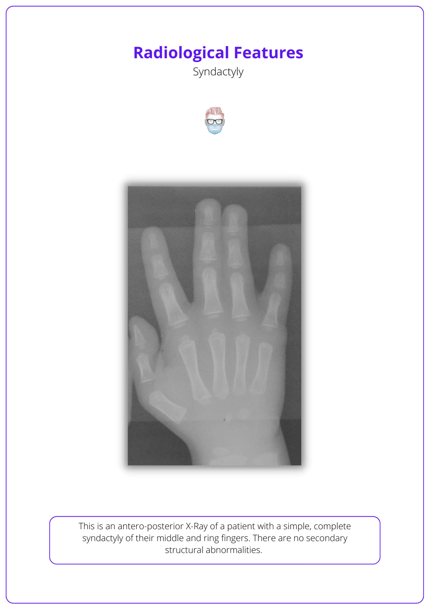 Radiological Features of Syndactyly, Syndactyly Diagnosis