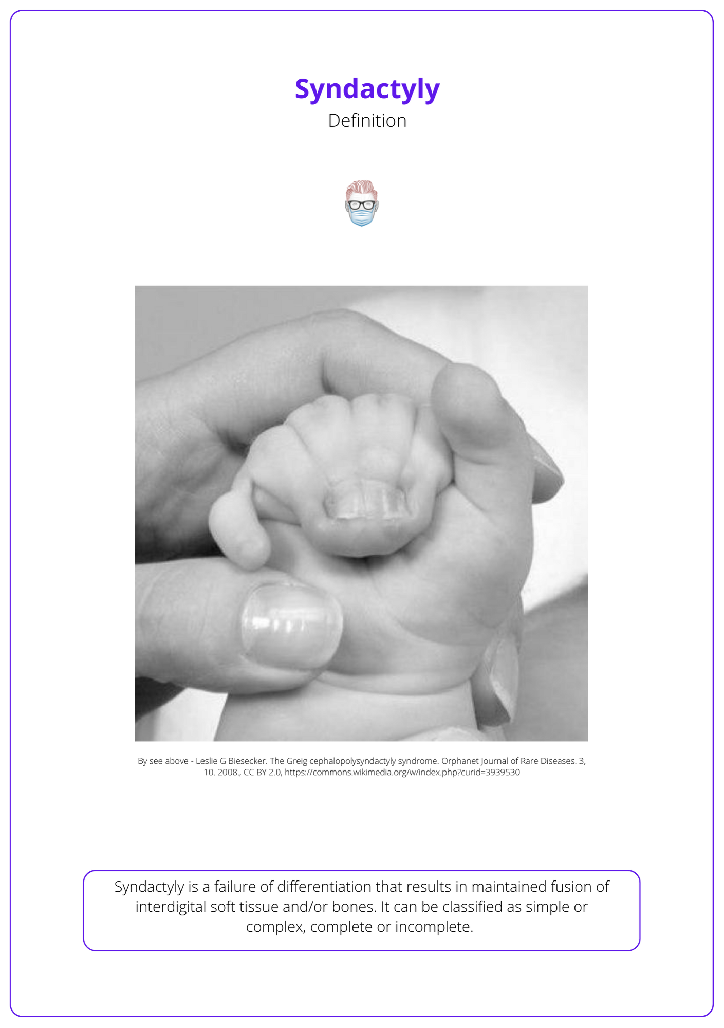 Definition and visual representation of Syndactyly