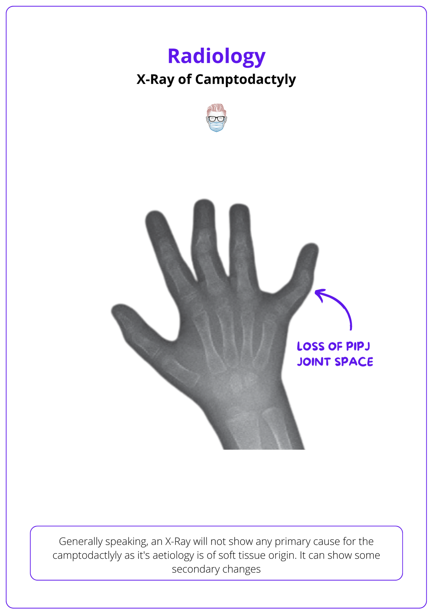 Camptodactyly X-ray view