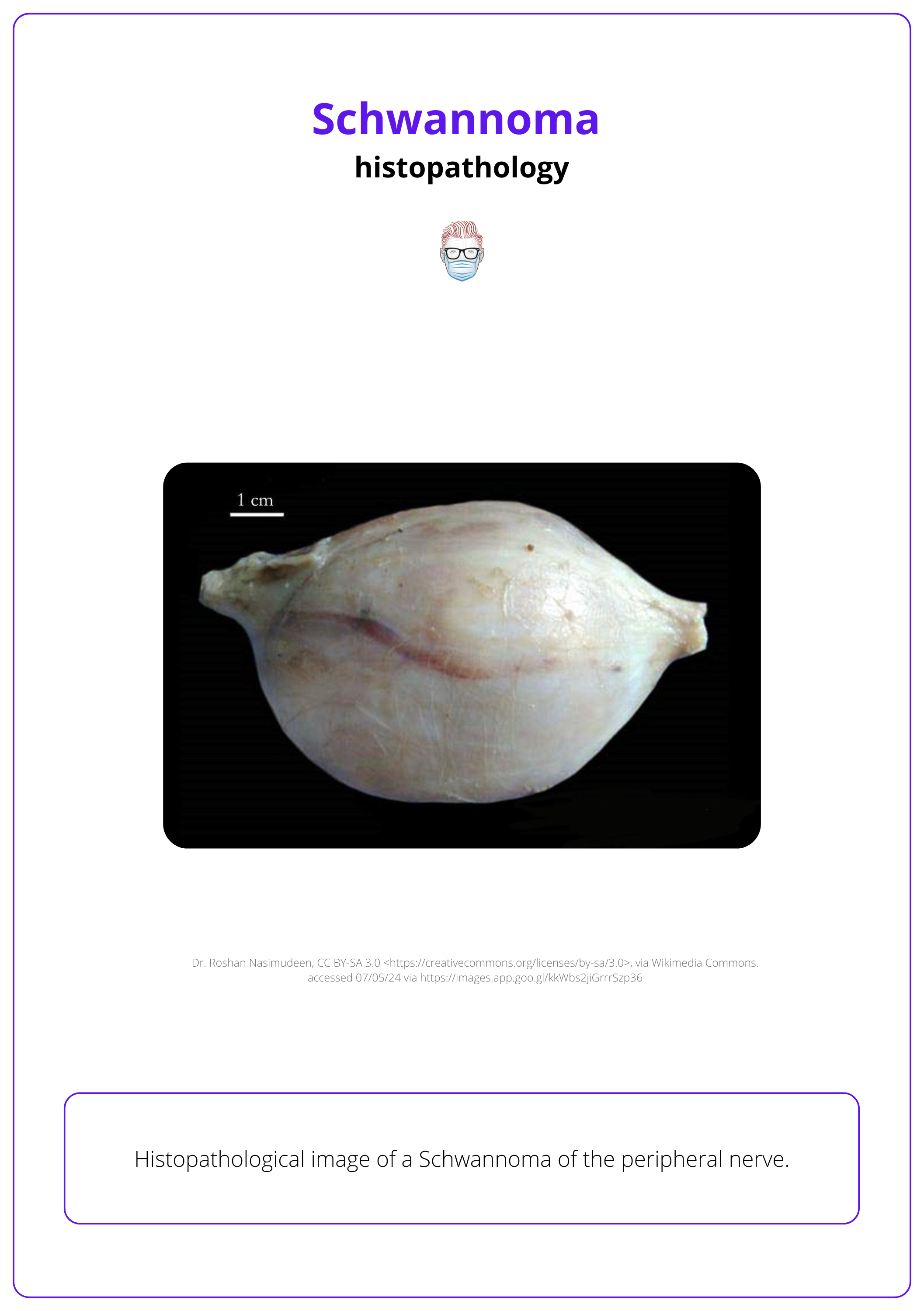 Encapsulated benign peripheral nerve tumour, Gross histology of Schwannoma of peripheral nerve. 