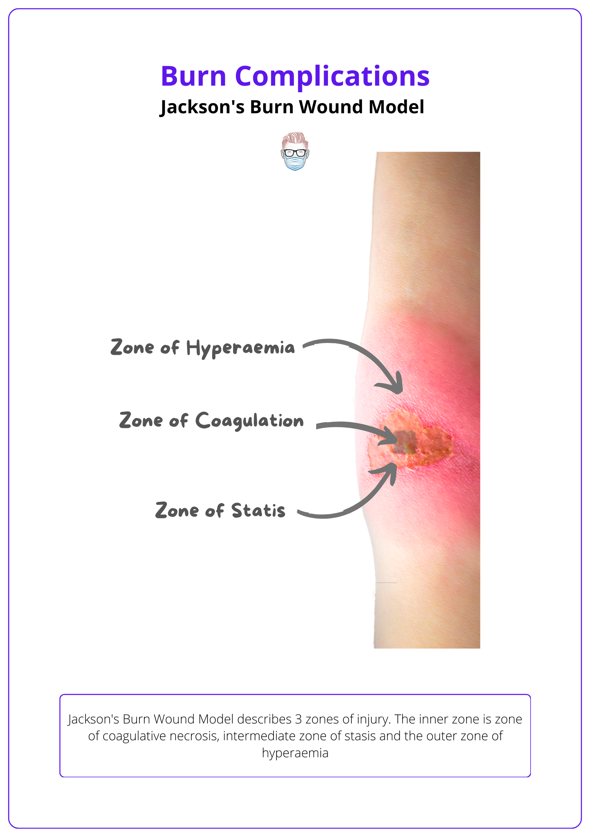This image shows Ganglion Cysts of the hand