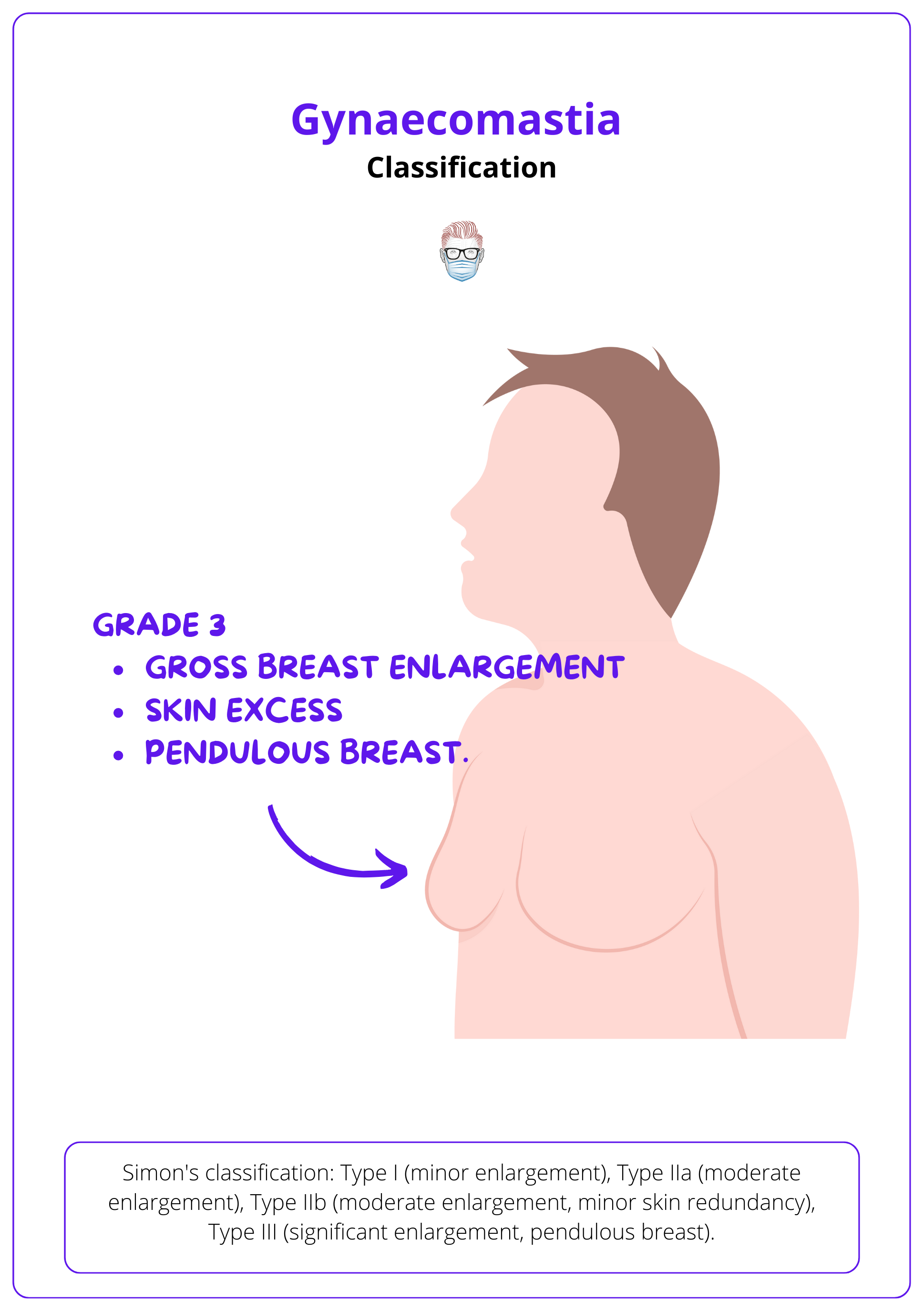 Simon Classification of Gynaecomastia, Gynecomastia