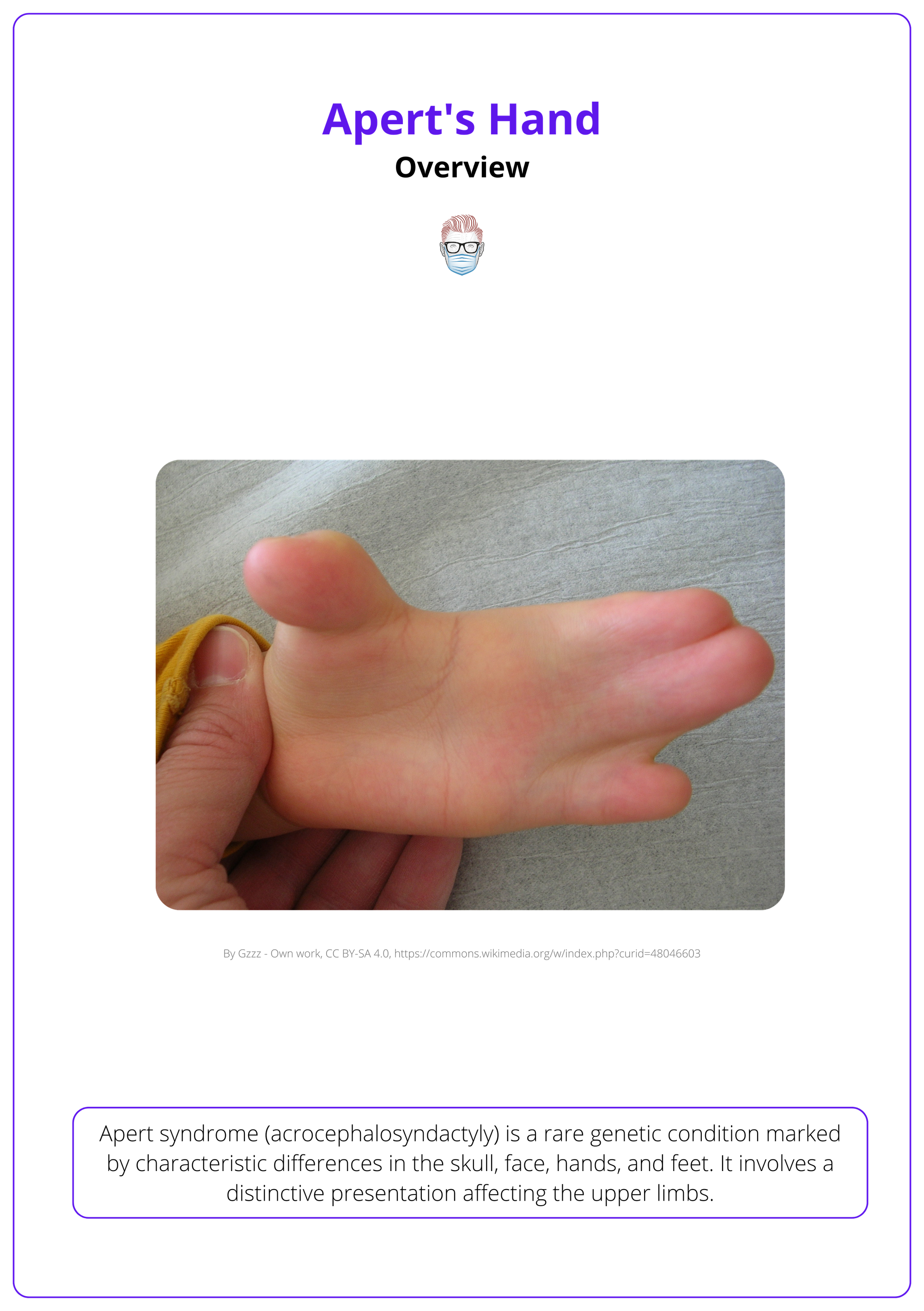 Definition and presentation of Apert's hand