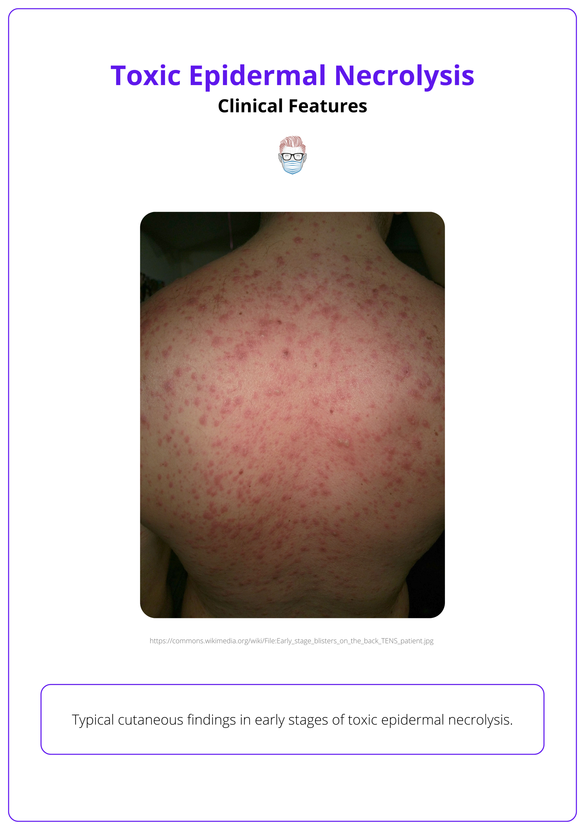 Toxic epidermal necrolysis, macules