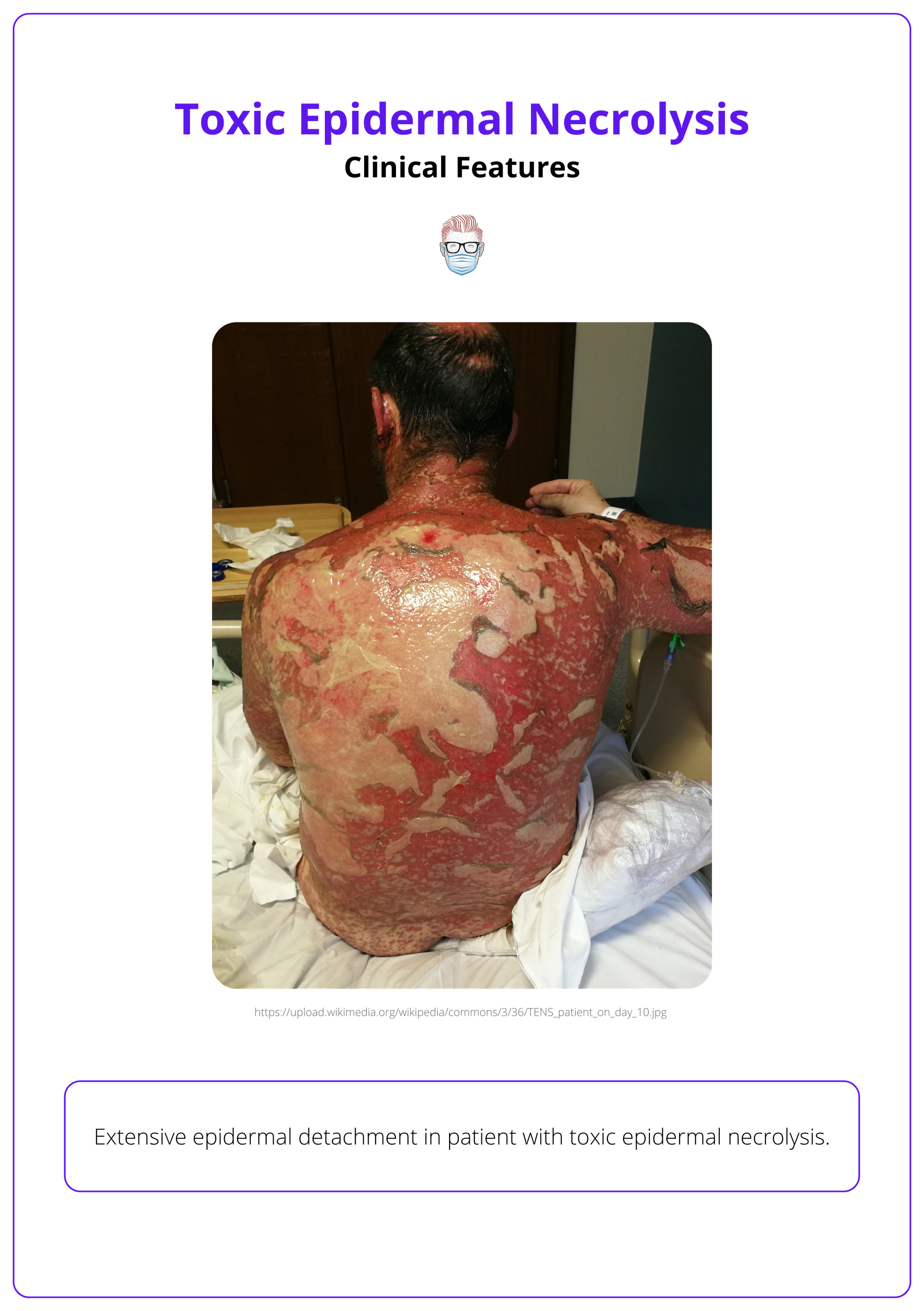 Epidermal sloughing, toxic epidermal necrolysis