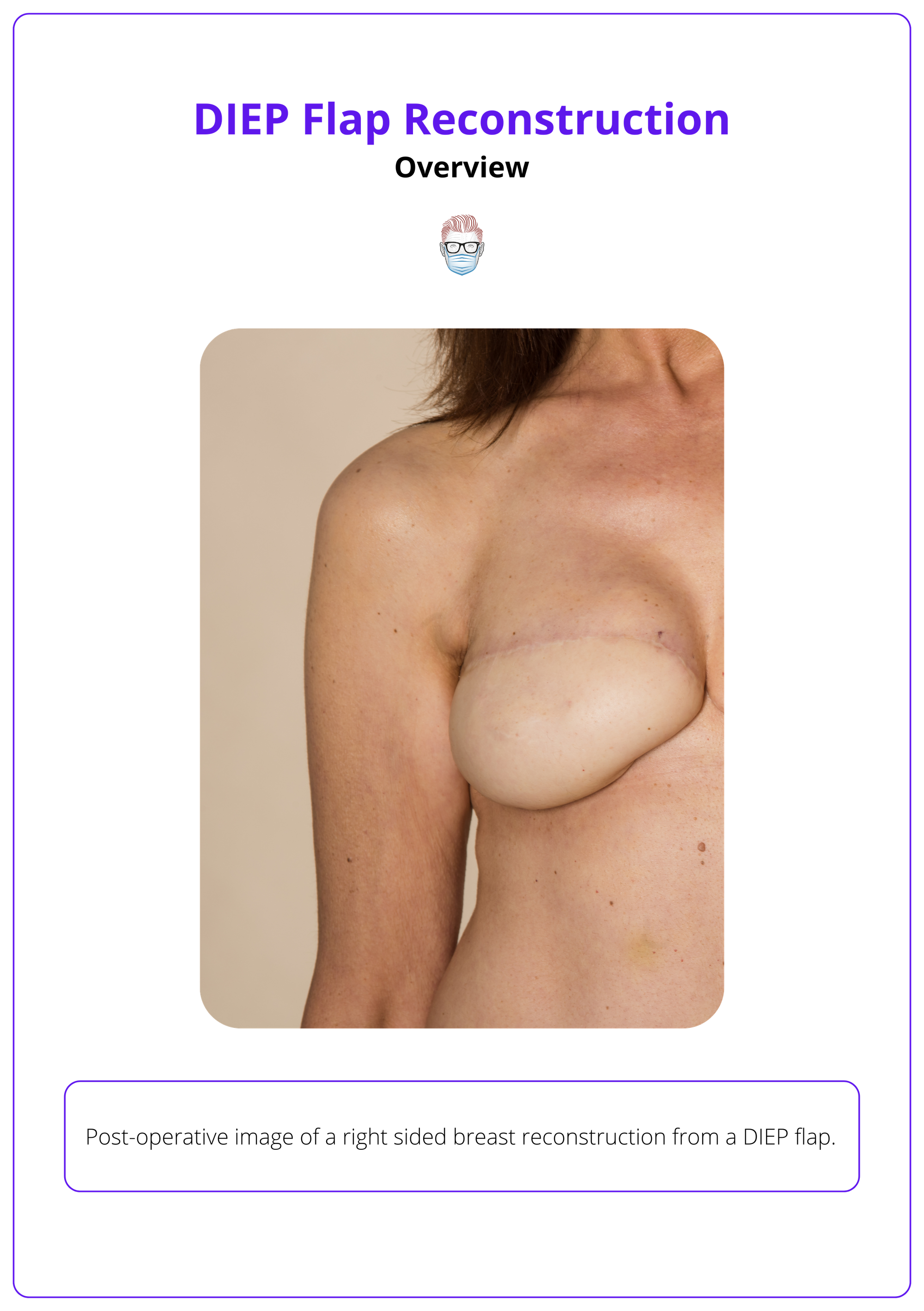Post-operative image of a right sided breast reconstruction from a DIEP flap. 