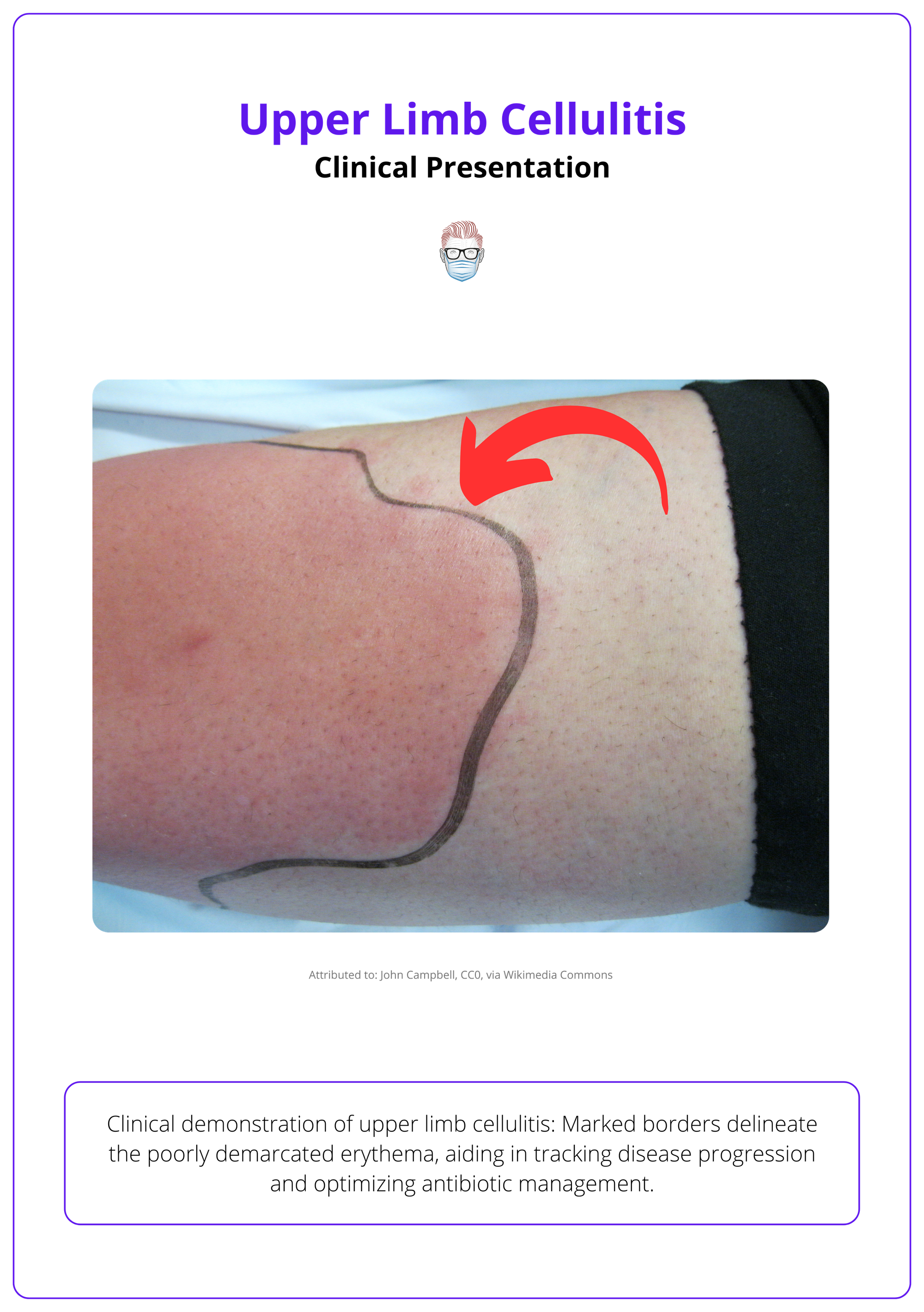 Clinical presentation of upper limb cellulitis