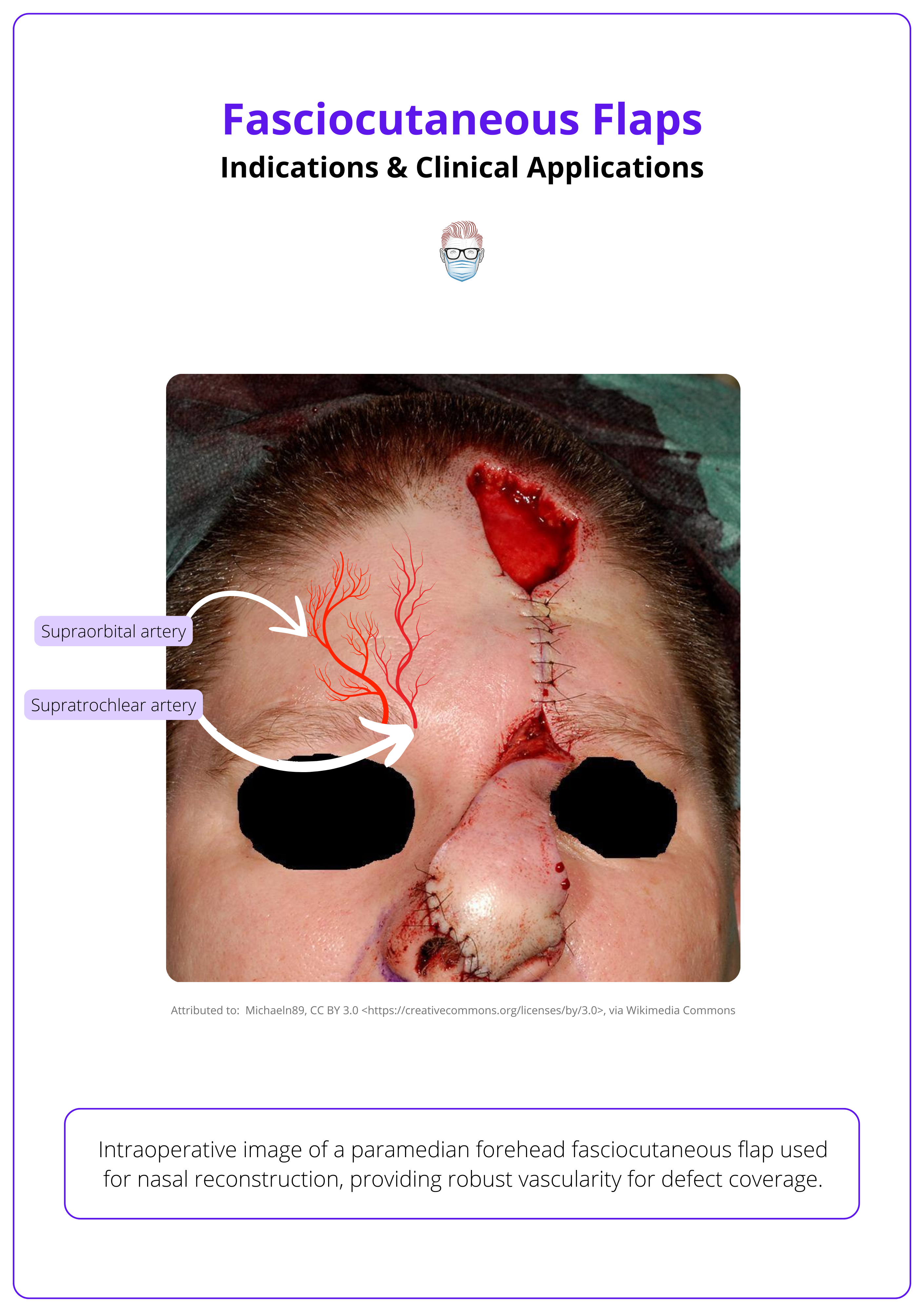 Forehead fasciocutaneous flap used for nasal reconstruction