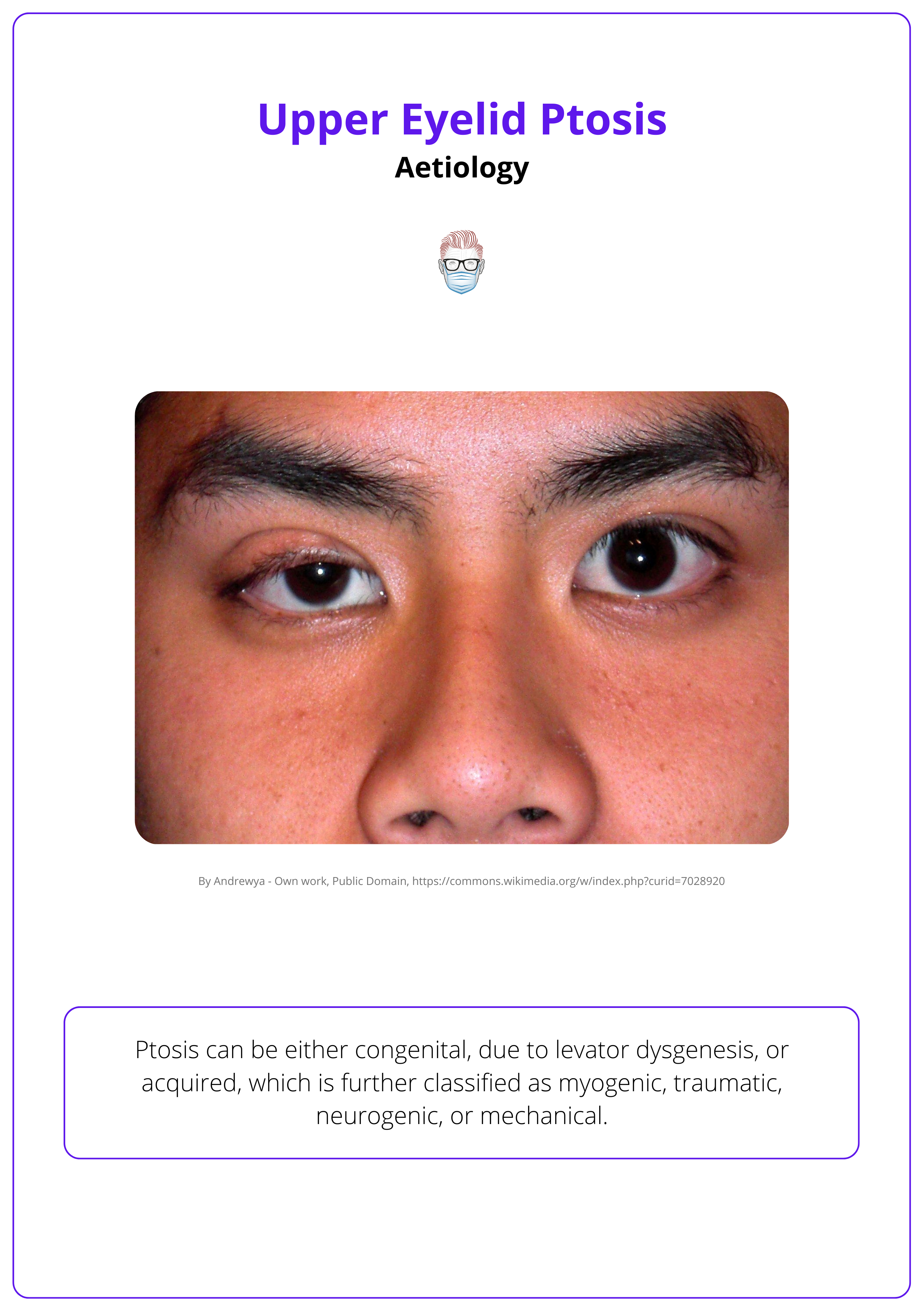 Mild right-eyelid ptosis