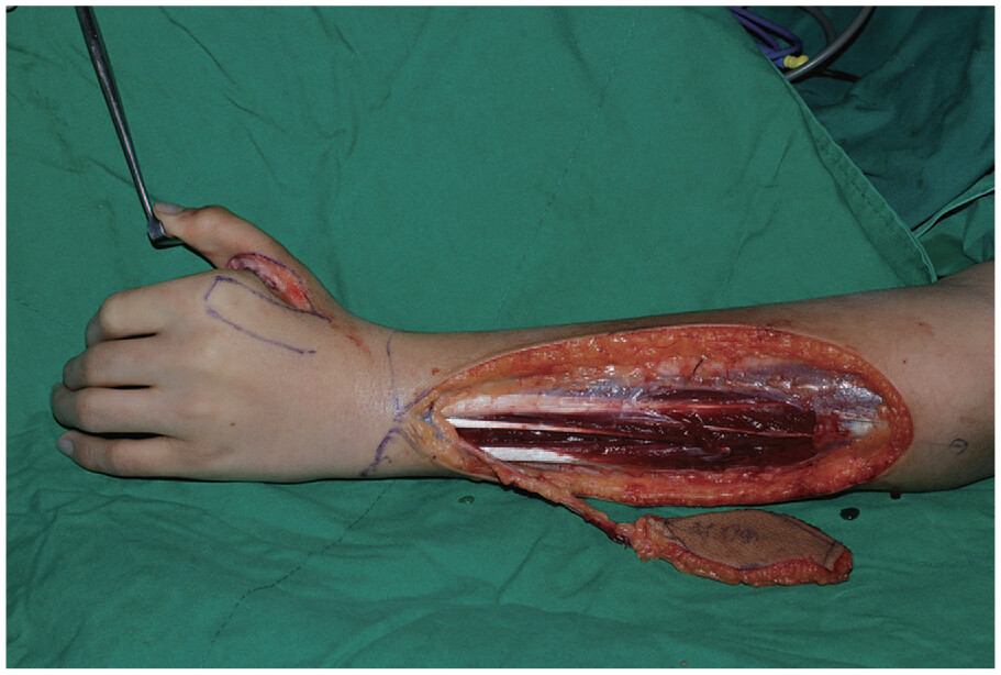 a raised PIA flap for dorsal hand and wrist reconstruction
