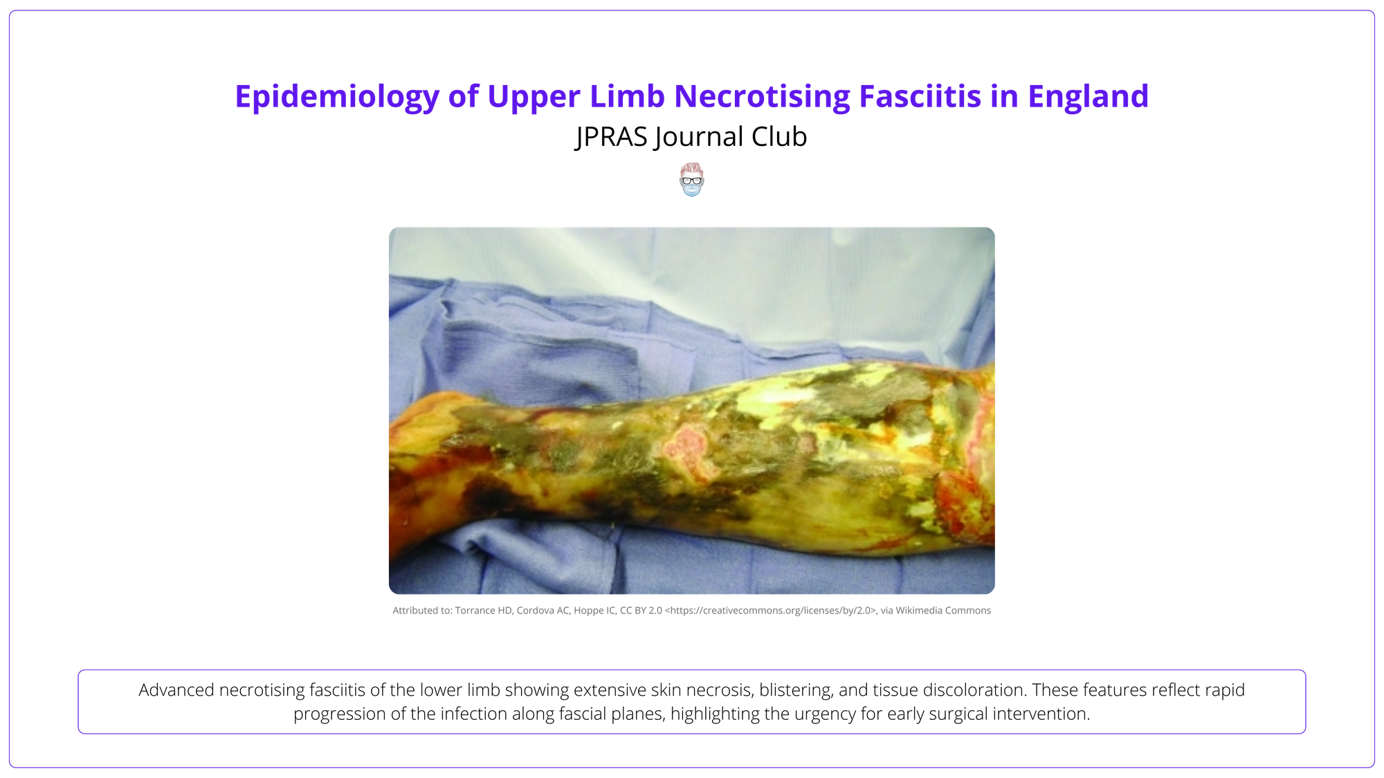 Advanced necrotising fasciitis of the lower limb showing extensive skin necrosis, blistering, and tissue discoloration.