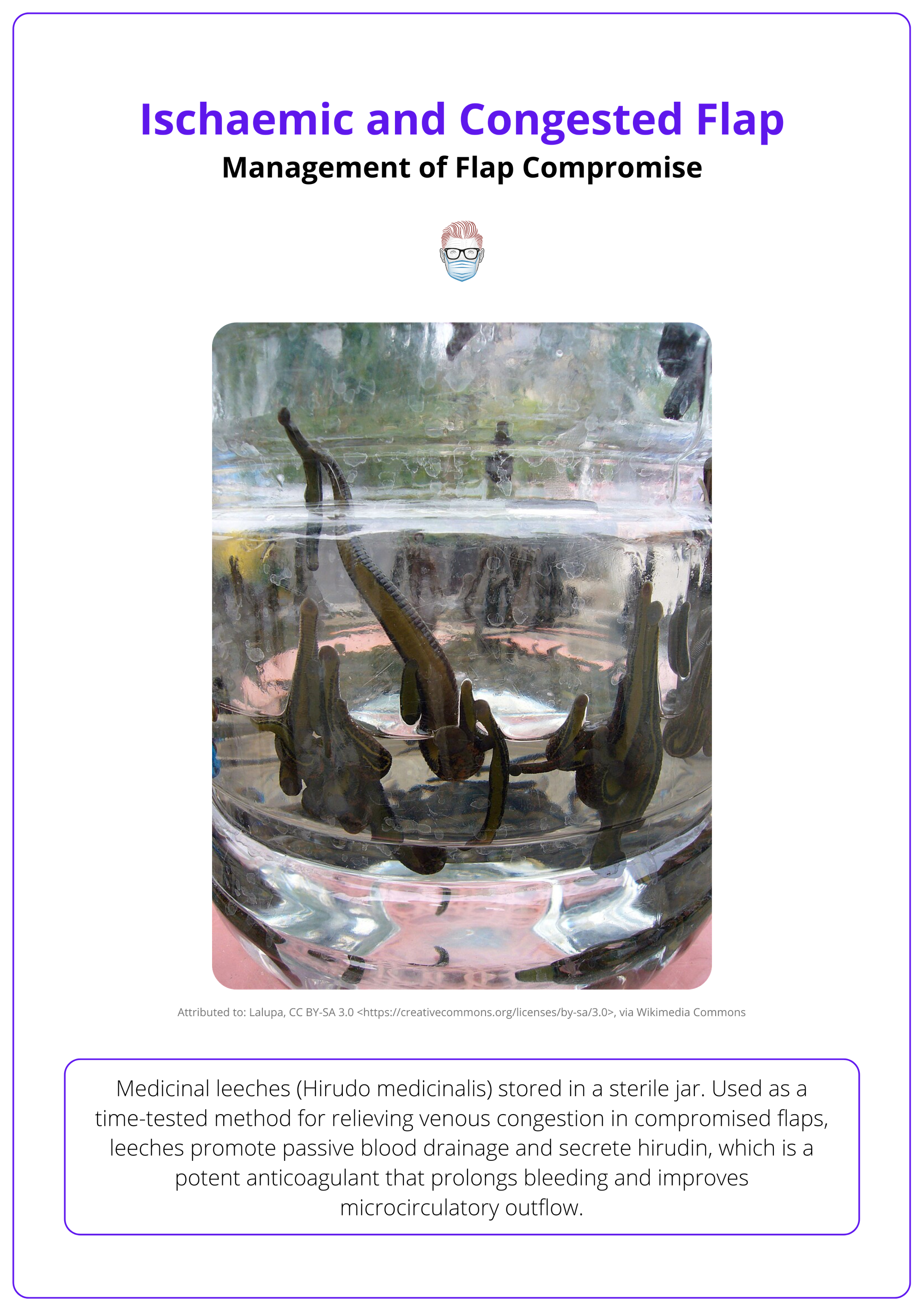 Leech therapy for venous congestion