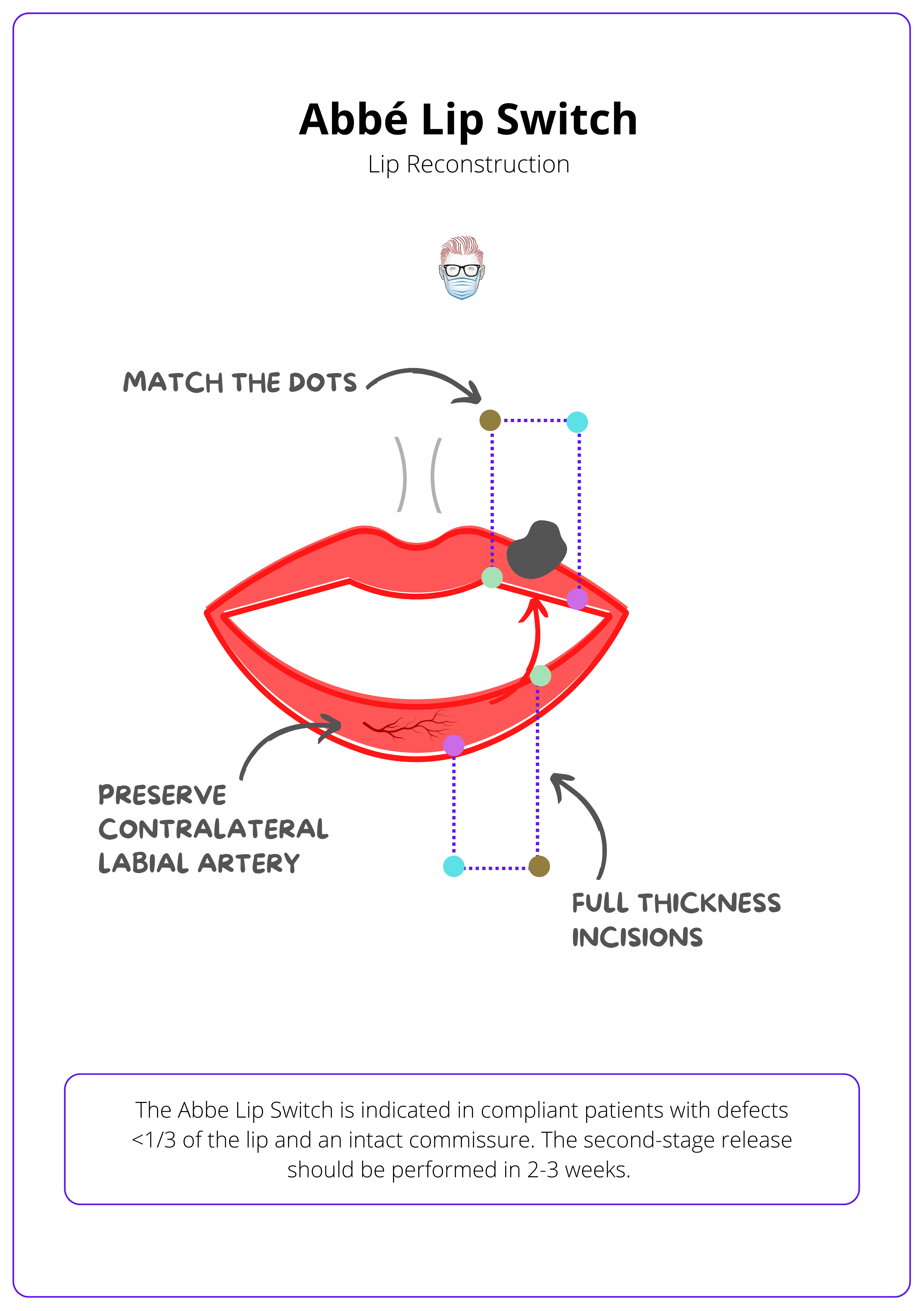 A labelled drawing of a red lip with a cancer. The lip is reconstruced with a blue dotted line to show a lip switch. Arrows show the arteries and incisions
