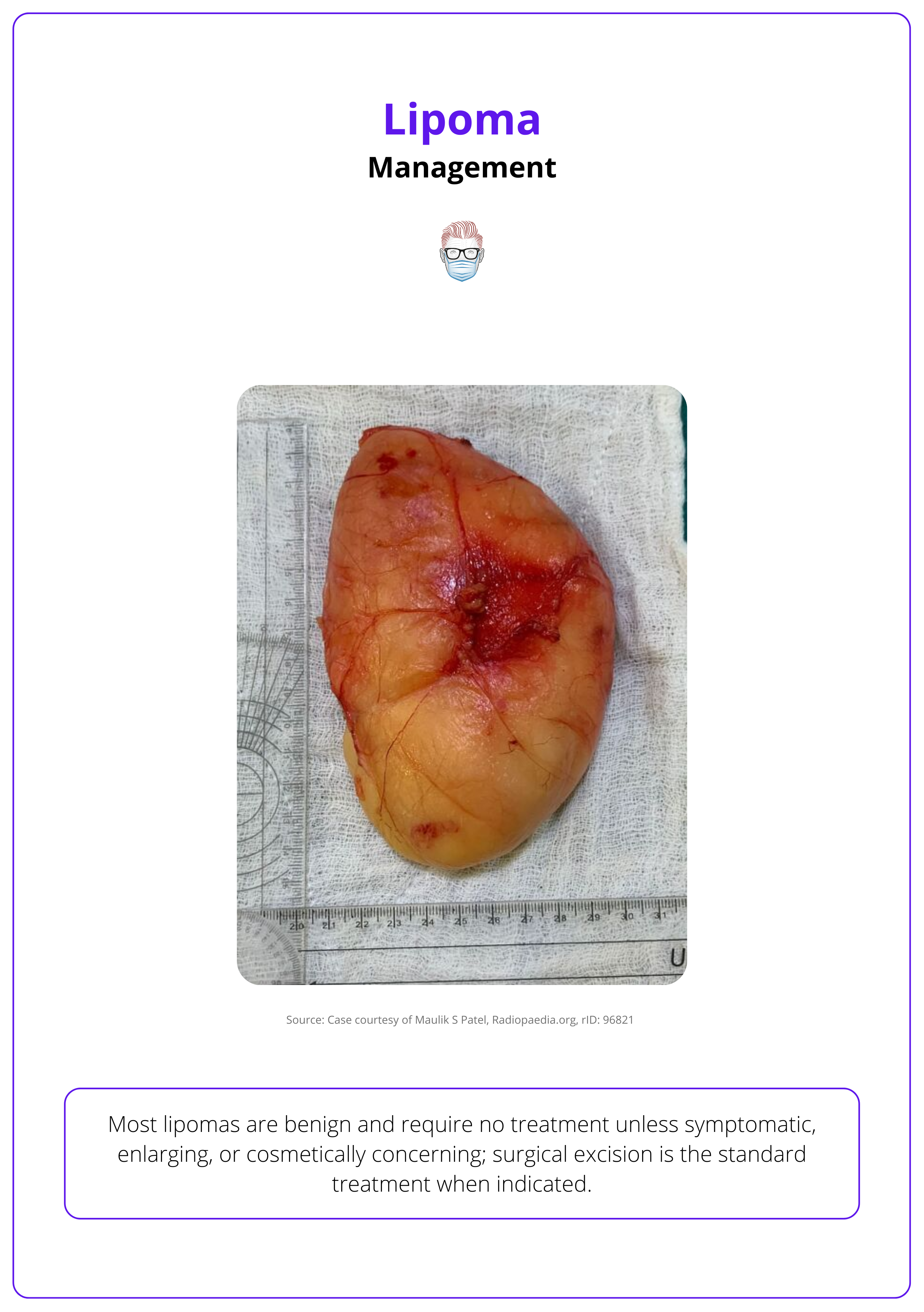 A well-encapsulated lipoma excised from the subcutaneous tissue