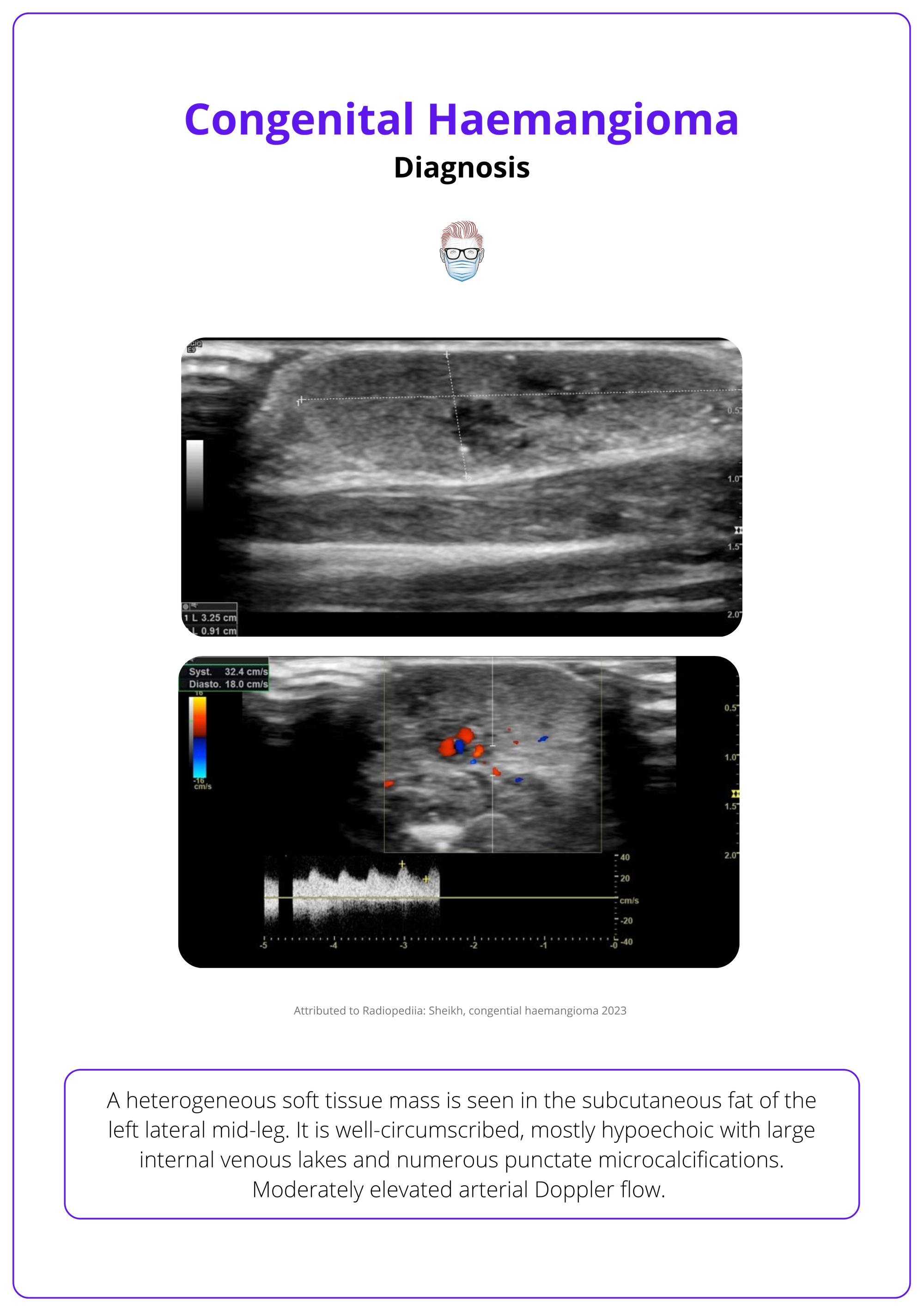 An ultrasound of a congenital haemangioma
