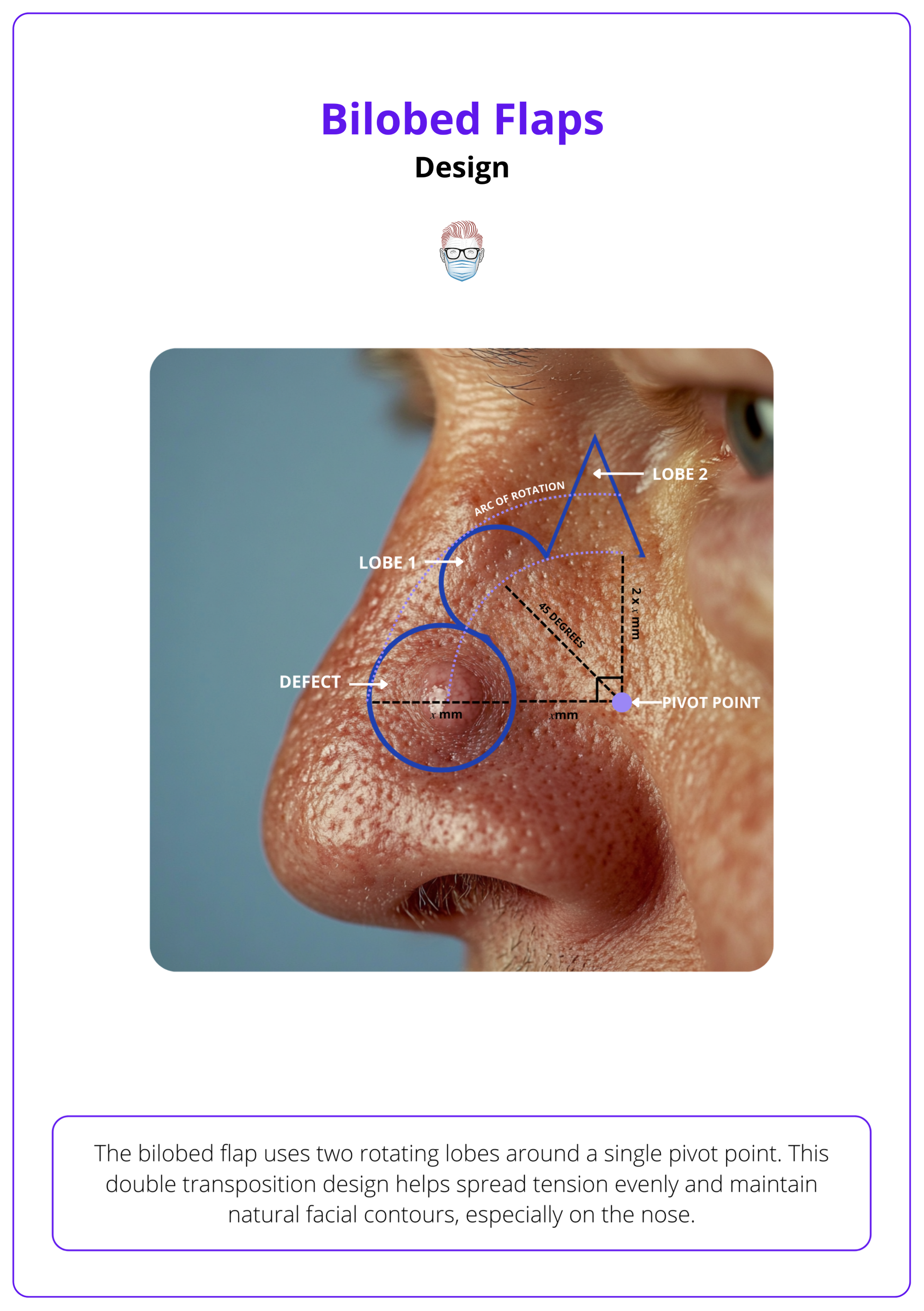 Steps of designing a bilobed flap