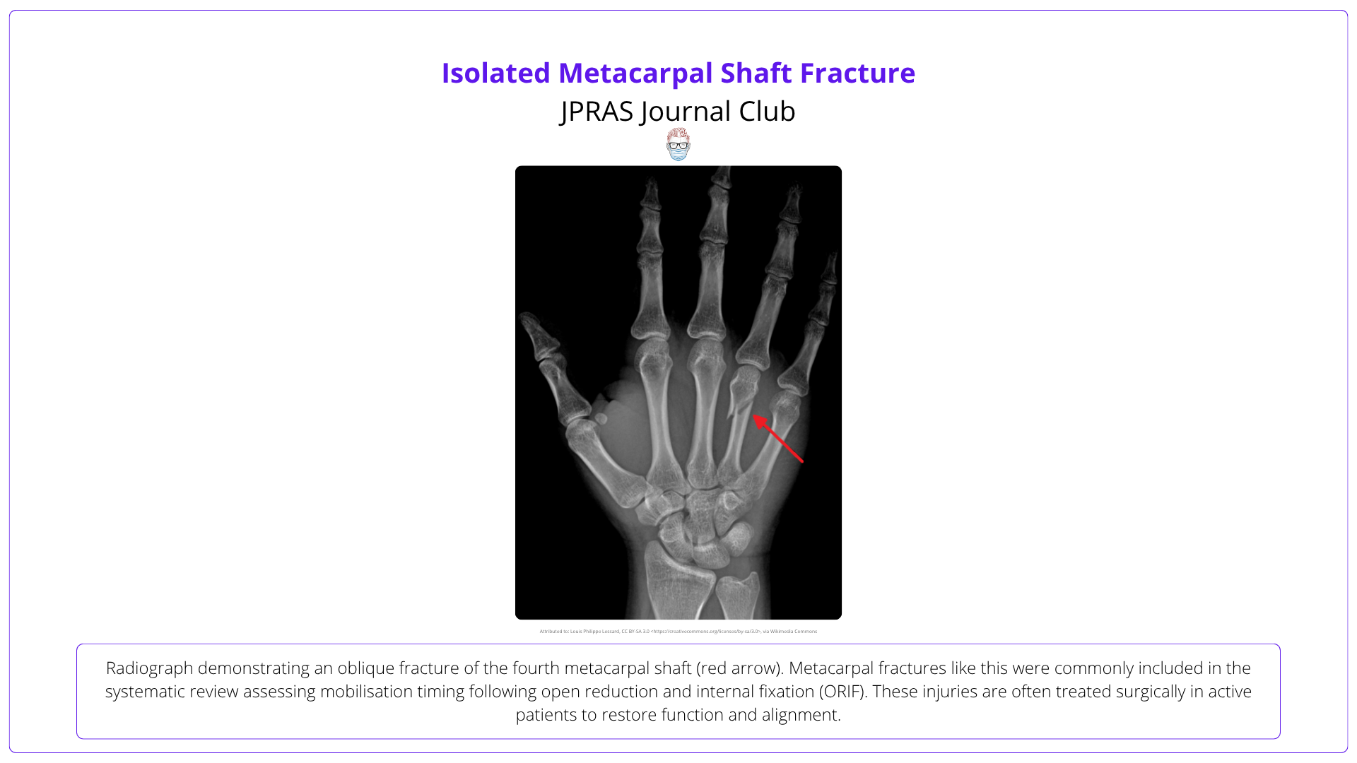 Isolated metacarpal shaft fracture