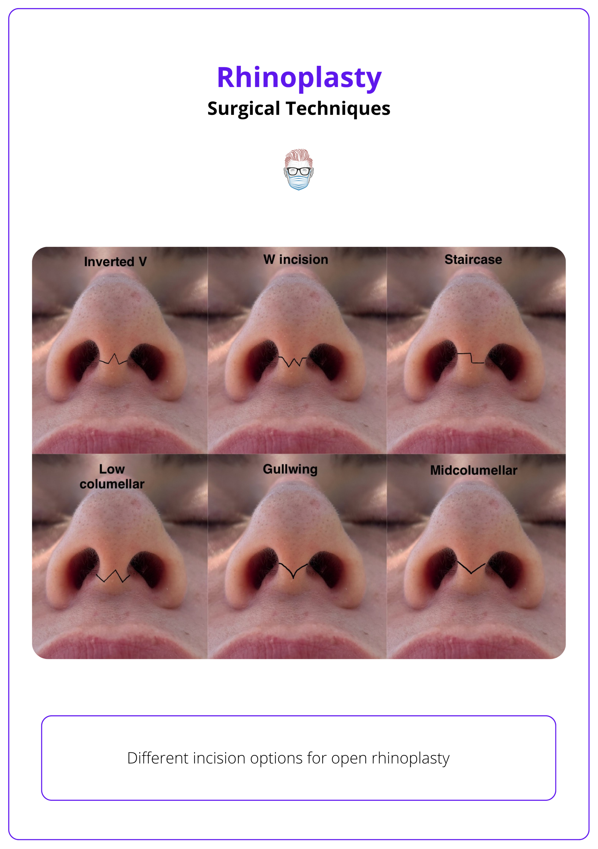 Incision options for open rhinoplasty