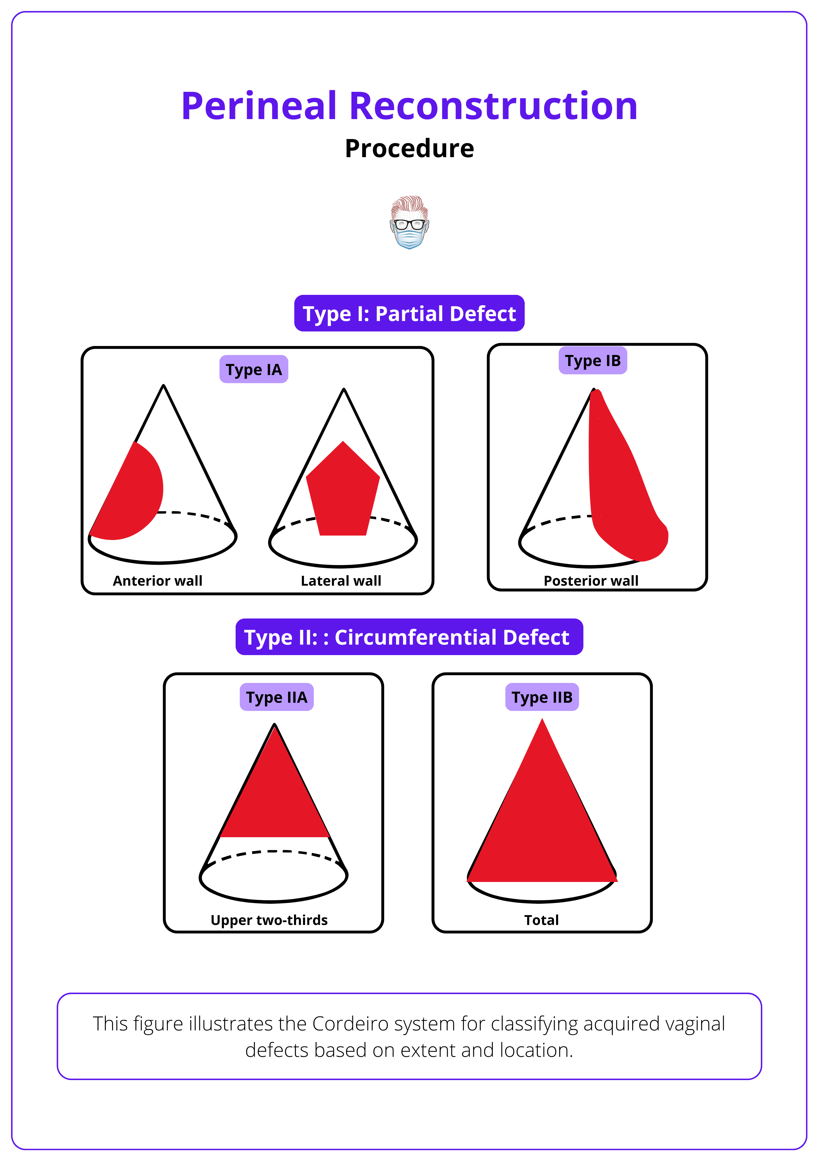 the Cordeiro system for classifying acquired vaginal defects based on extent and location.