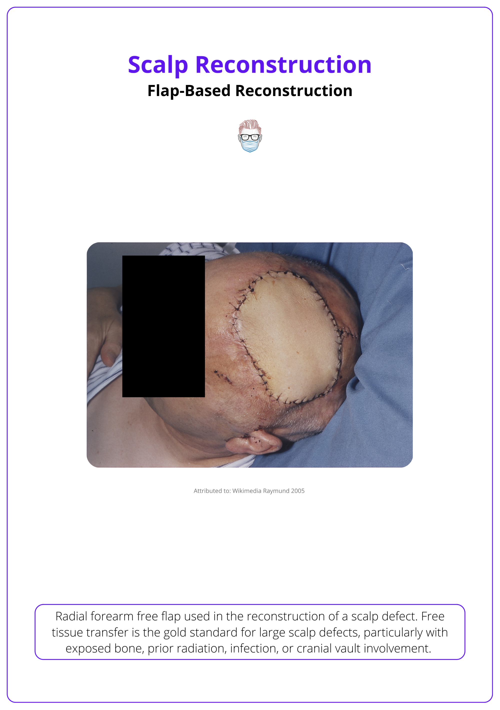 Radial forearm free flap used for scalp reconstruction