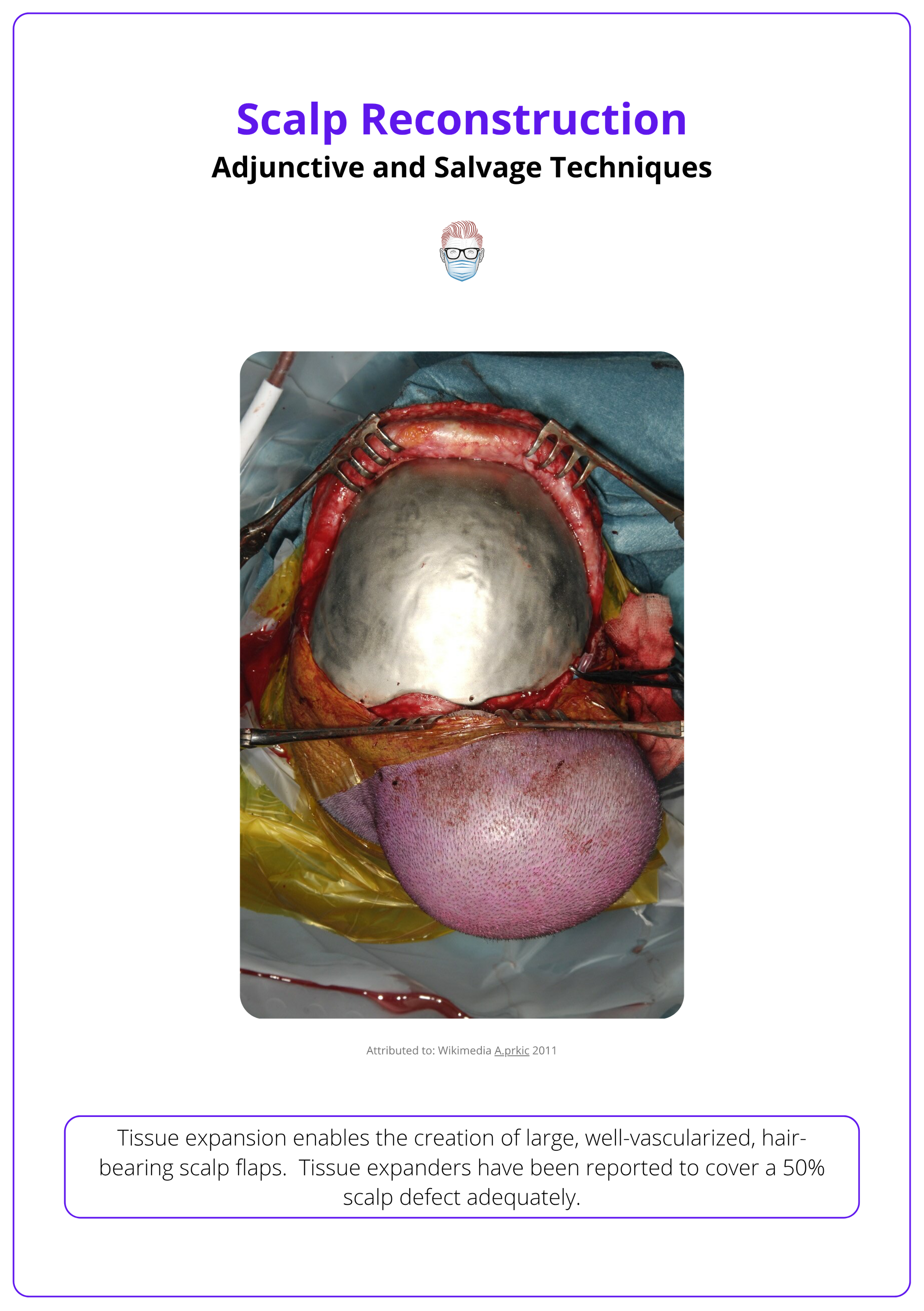 Tissue expander being used in scalp reconstruction