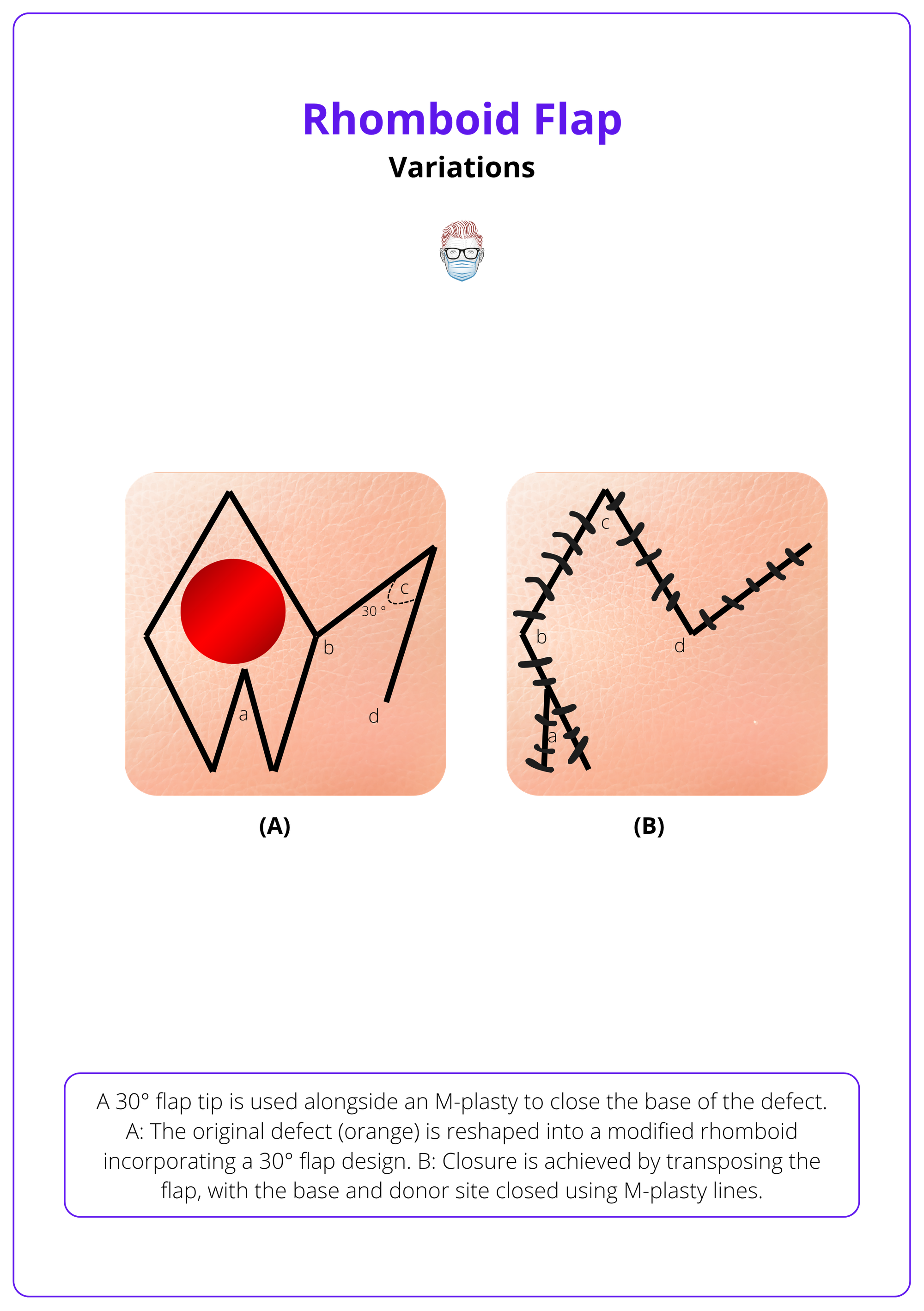 Webster rhombic flap