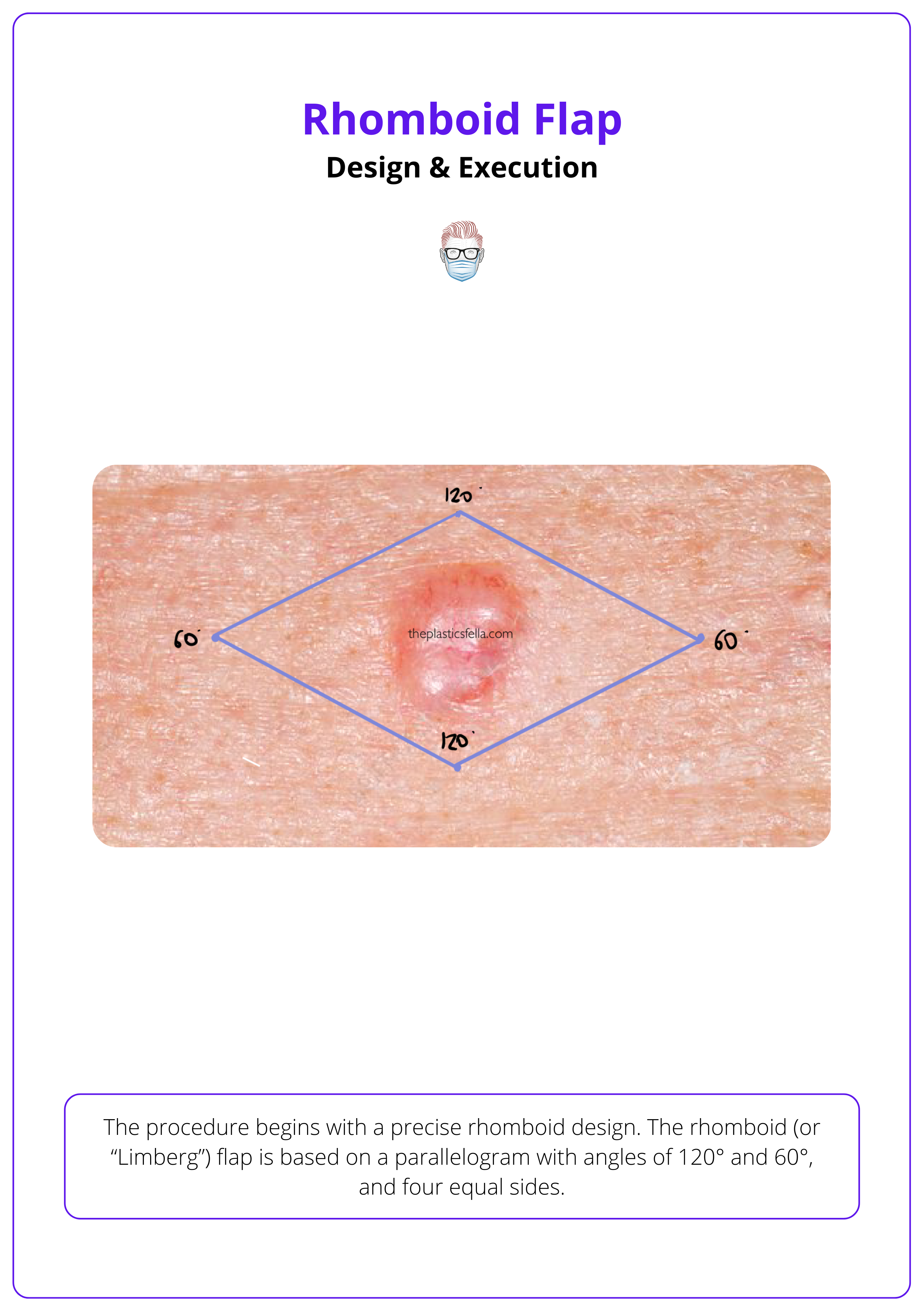 Rhomboid flap design