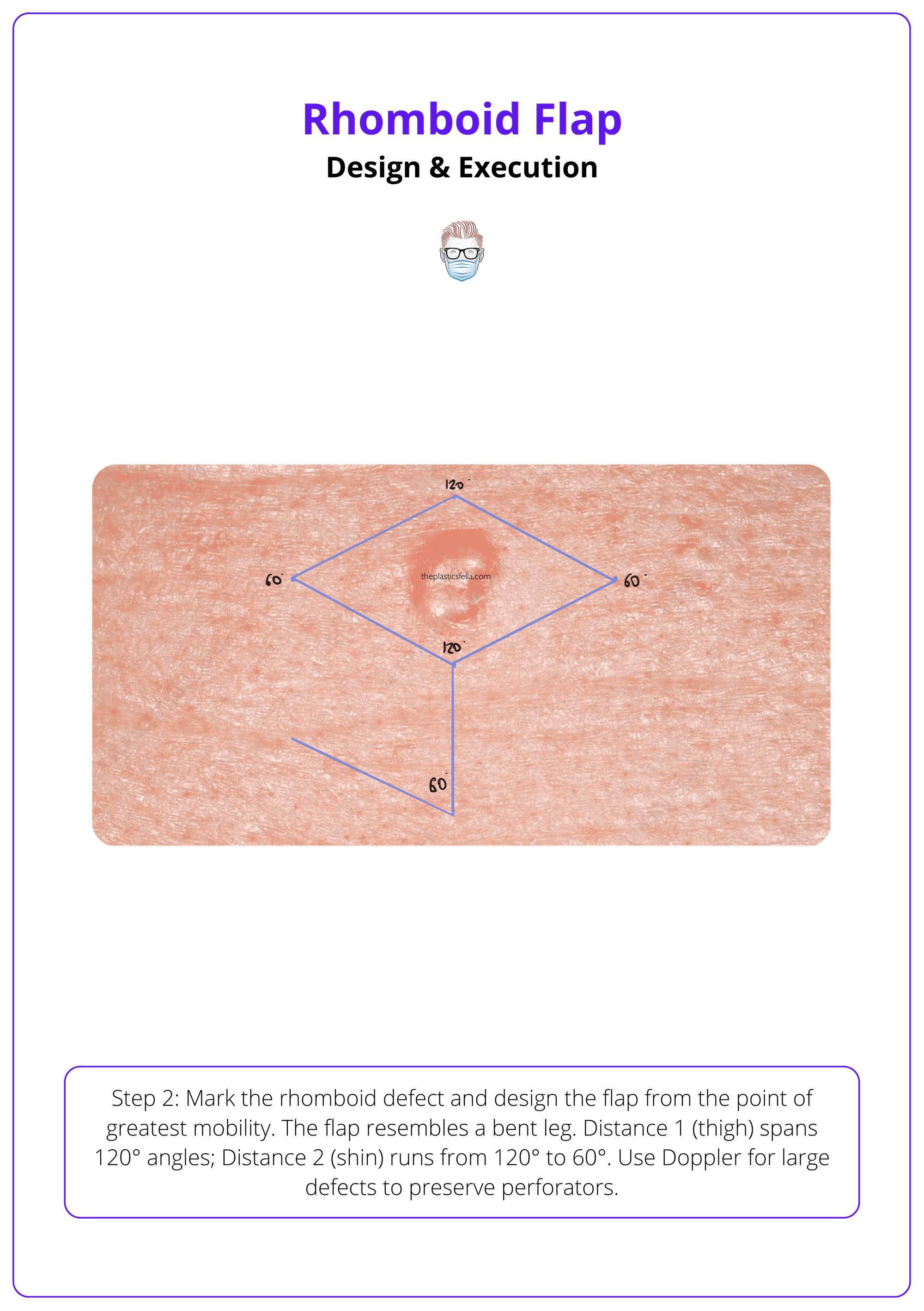 Marking and preparing a rhomboid flap