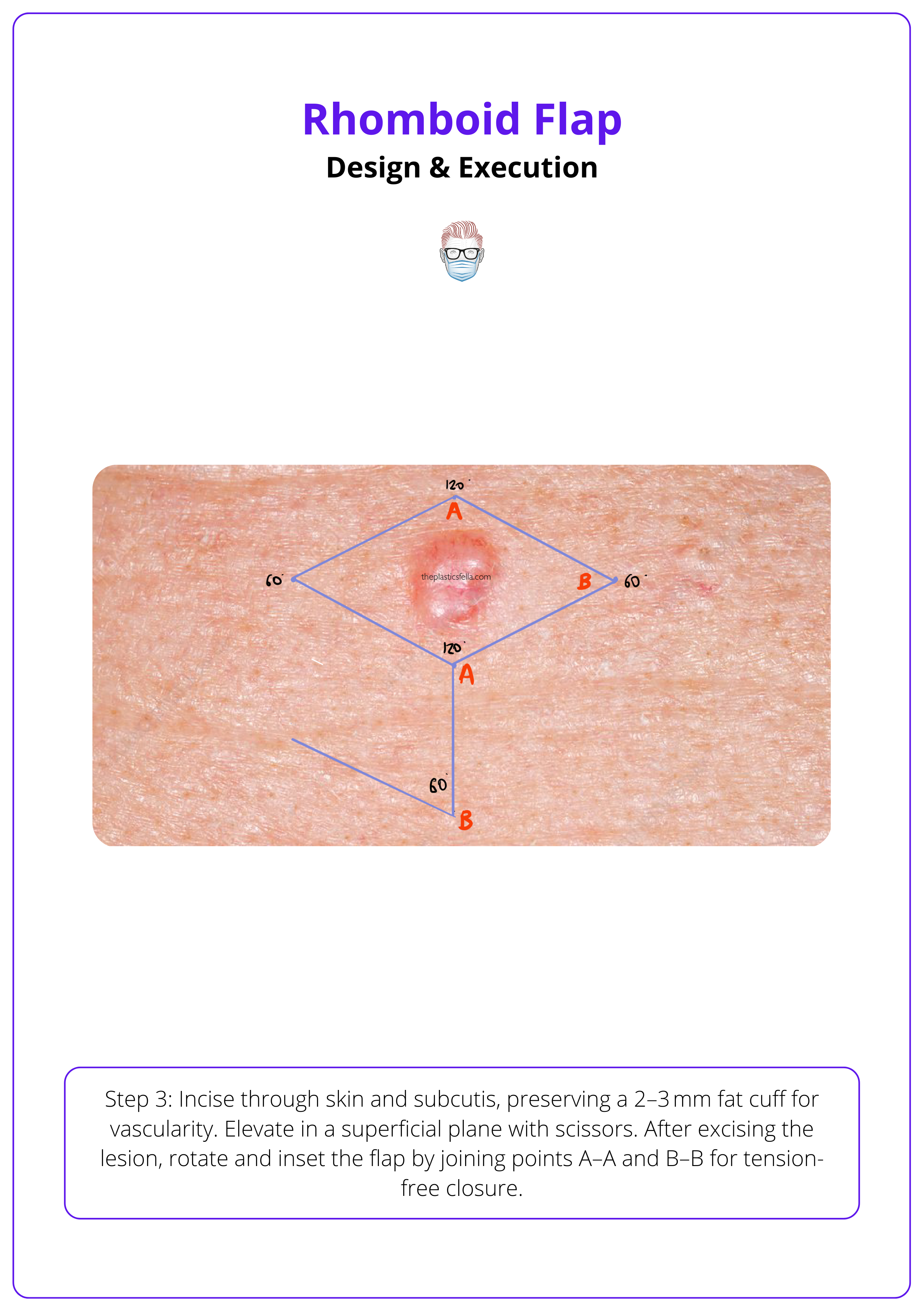 Incision & elevation of a rhomboid flap