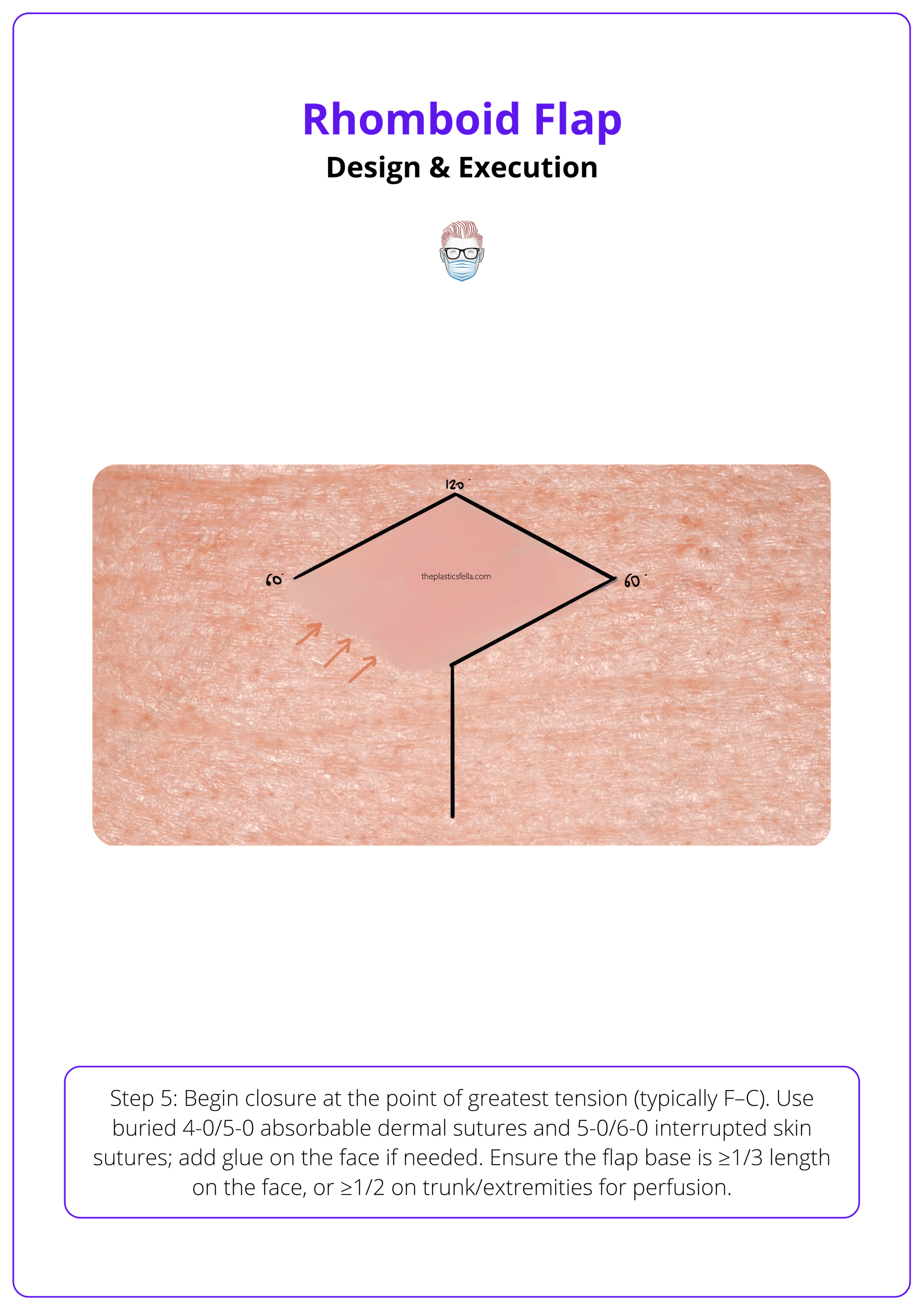 Insertion and closure of a rhomboid flap