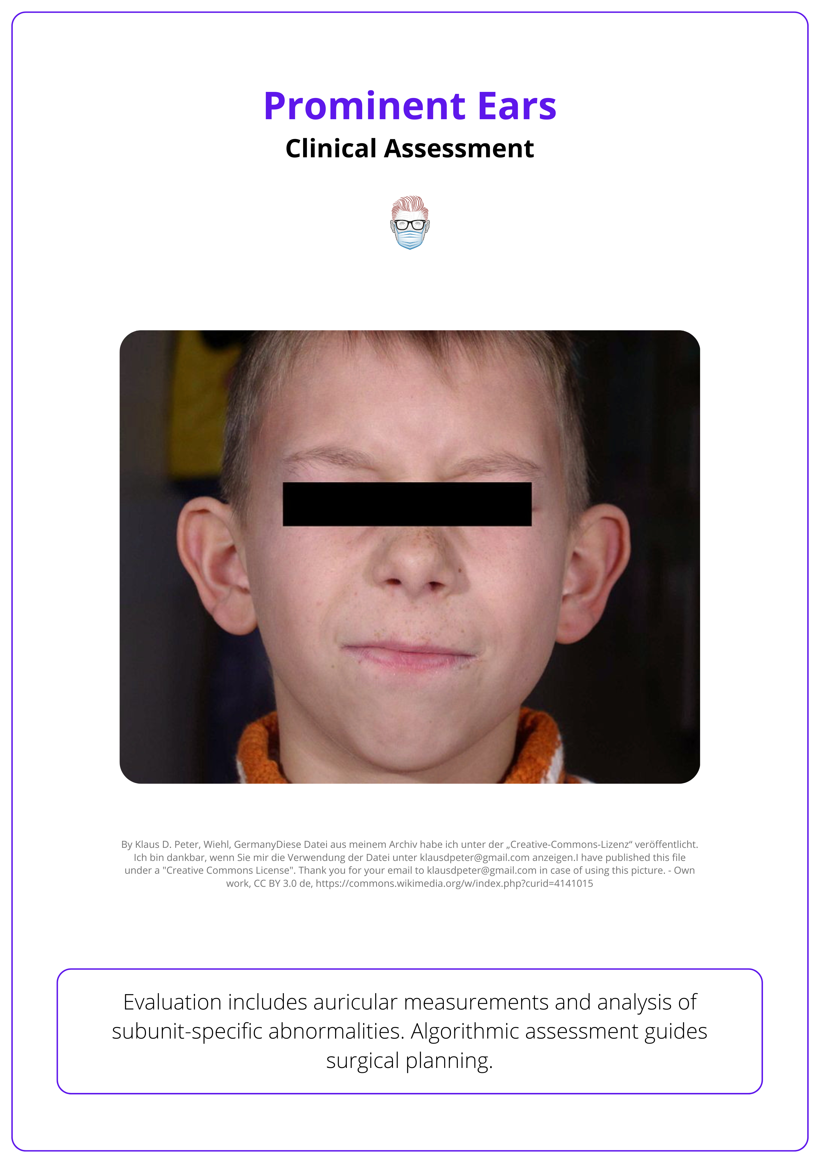 Clinical presentation of otapostasis. Prominent ear