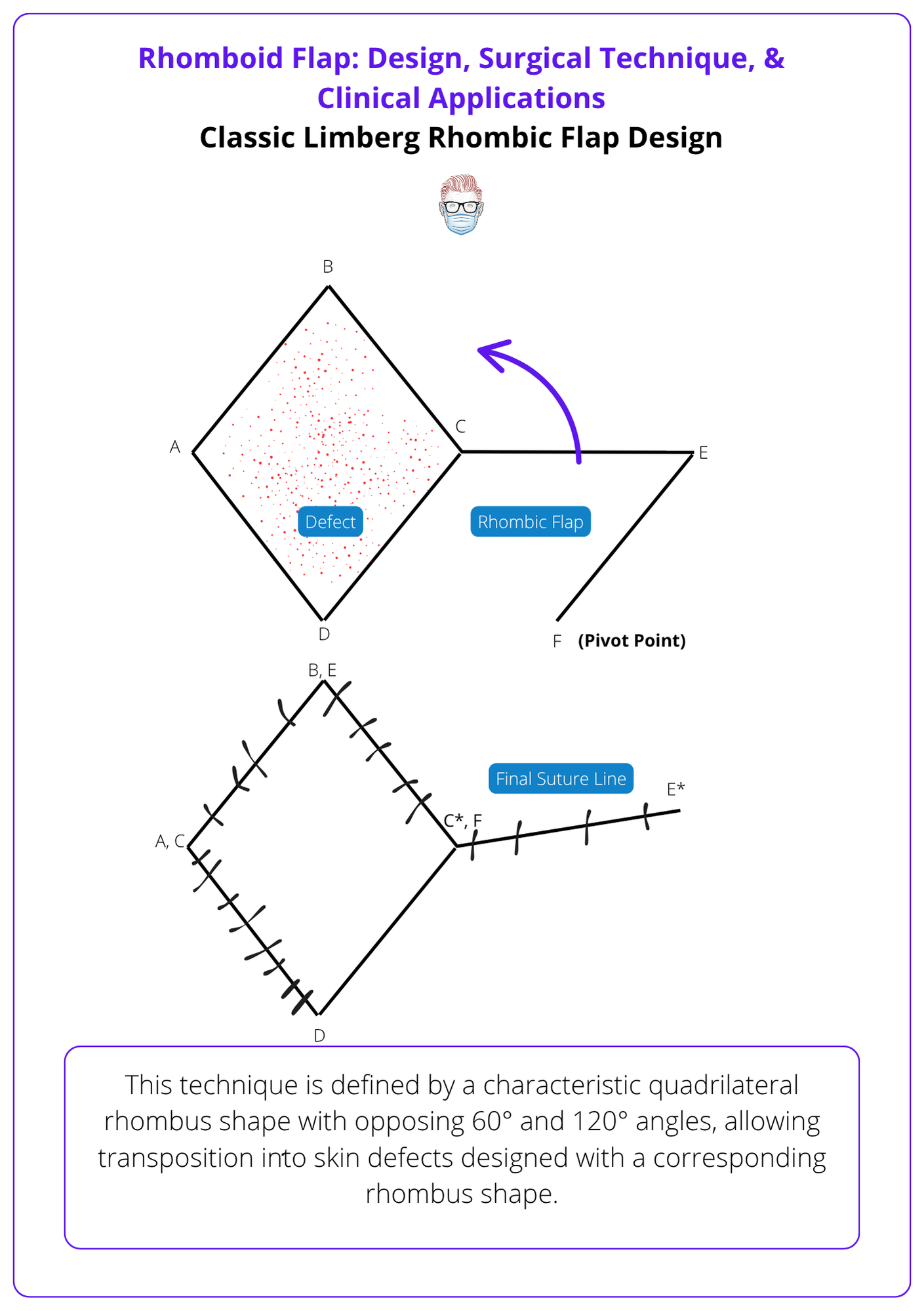 A classic Limberg rhombic flap design