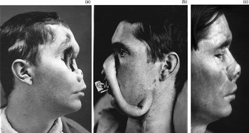 Harold Gillies Reconstruction